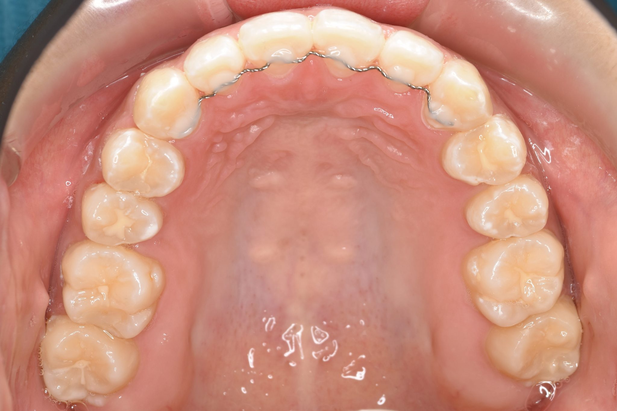 全顎ワイヤー矯正　症例_839