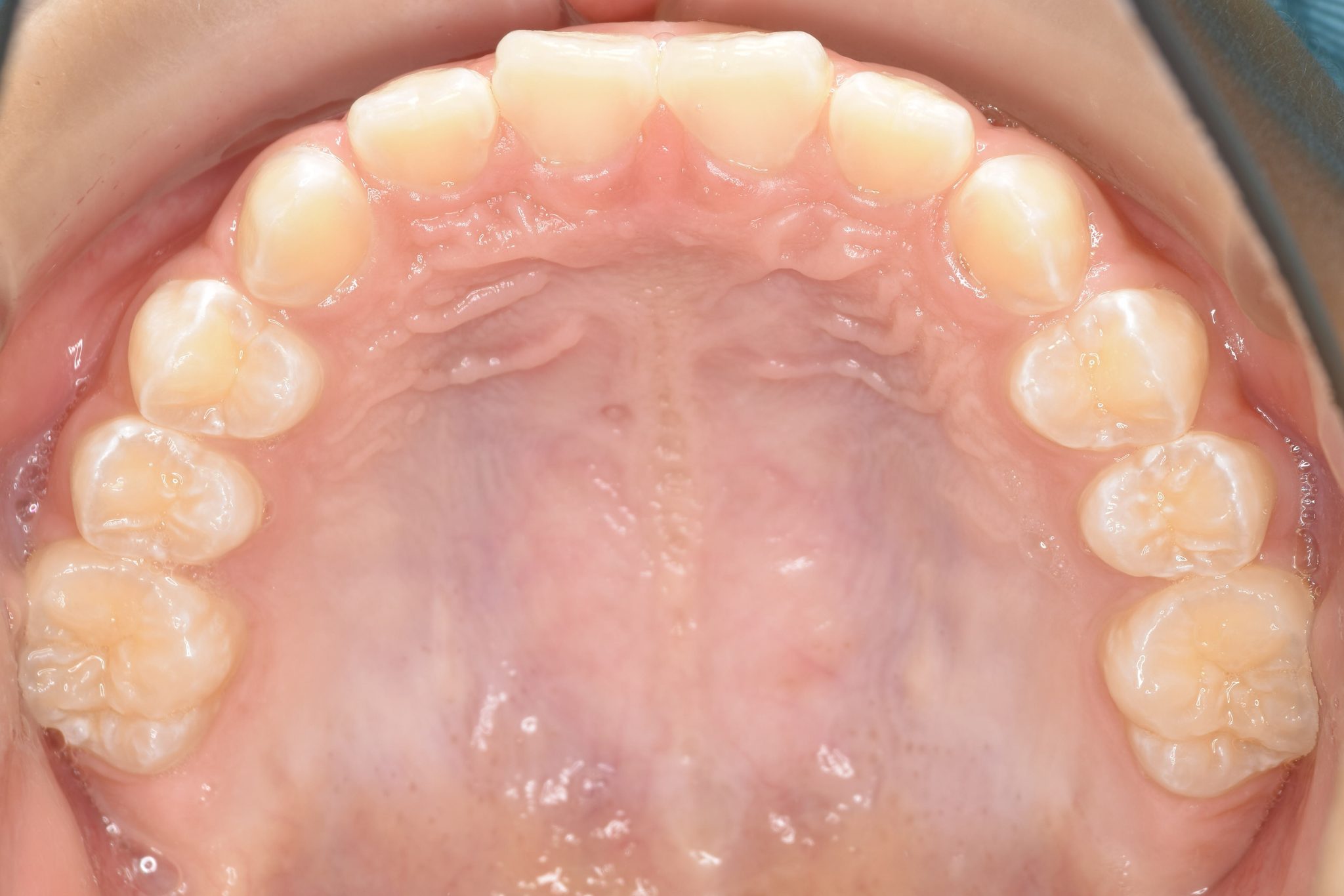 全顎ワイヤー矯正　症例_858