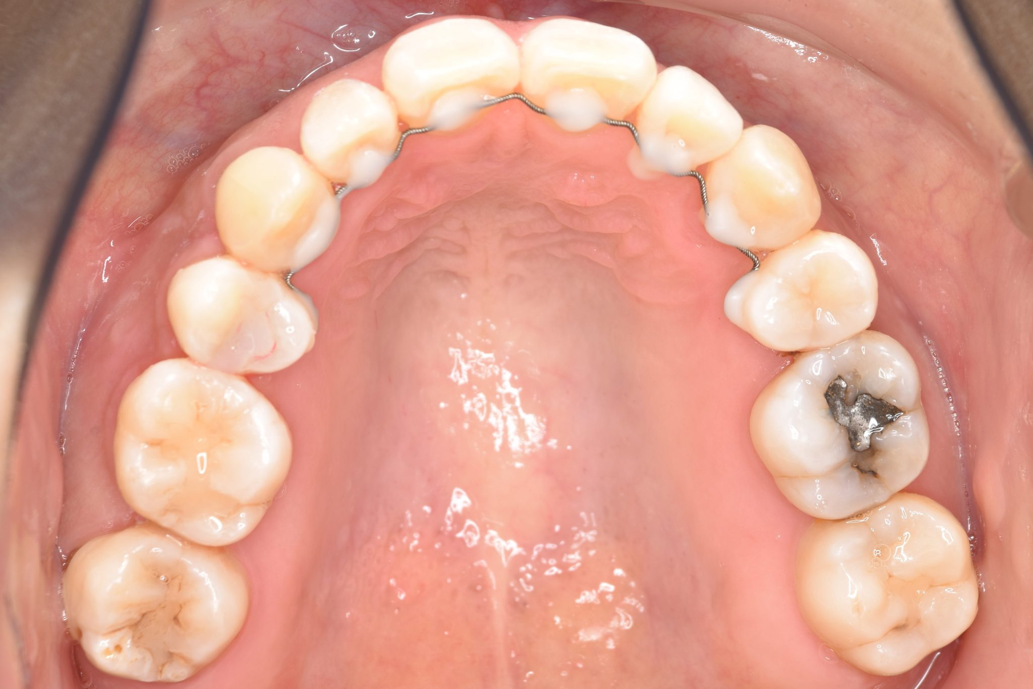 全顎ワイヤー矯正　症例_141