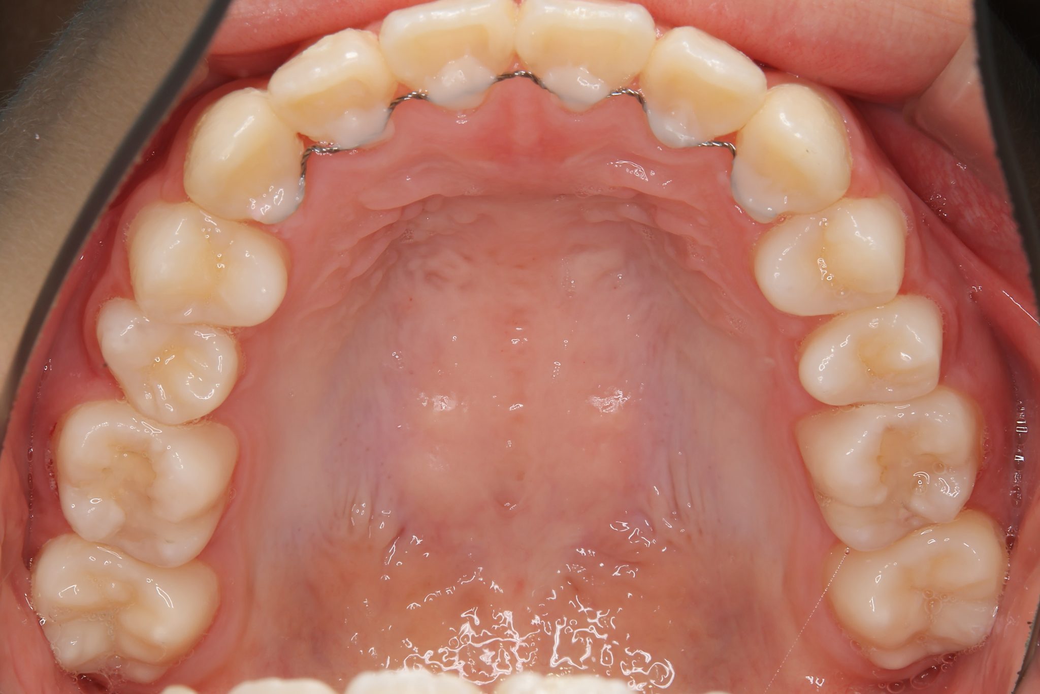 全顎ワイヤー矯正　症例_1324