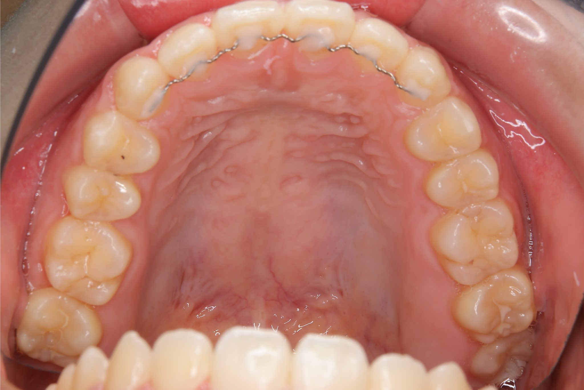全顎ワイヤー矯正　症例_1409