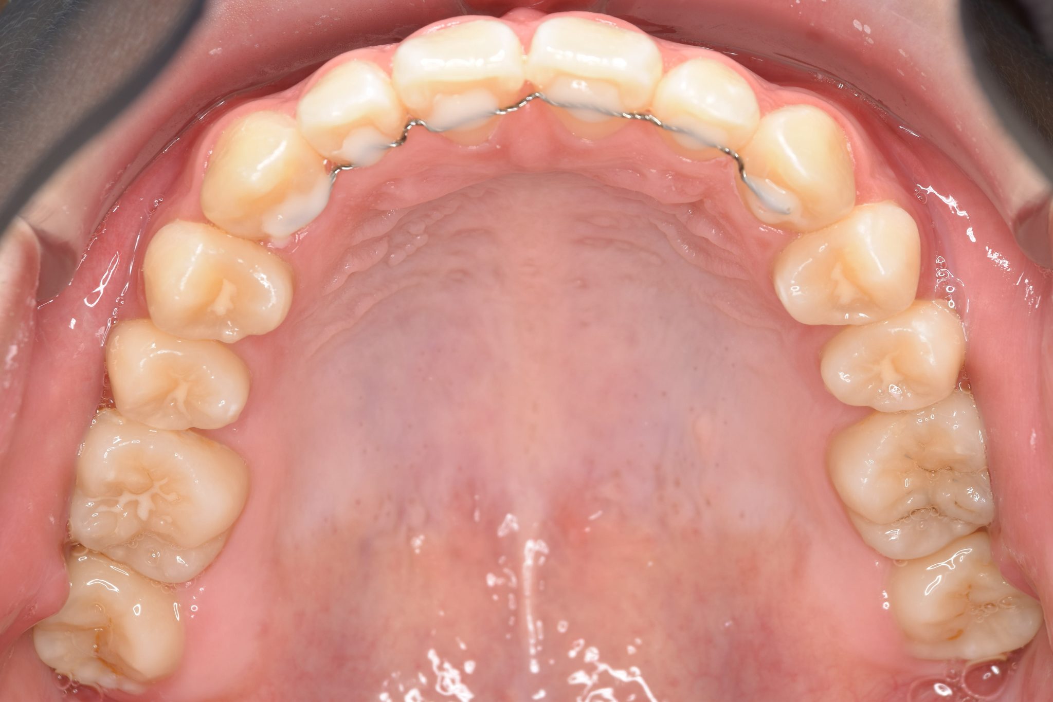 全顎ワイヤー矯正　症例_154