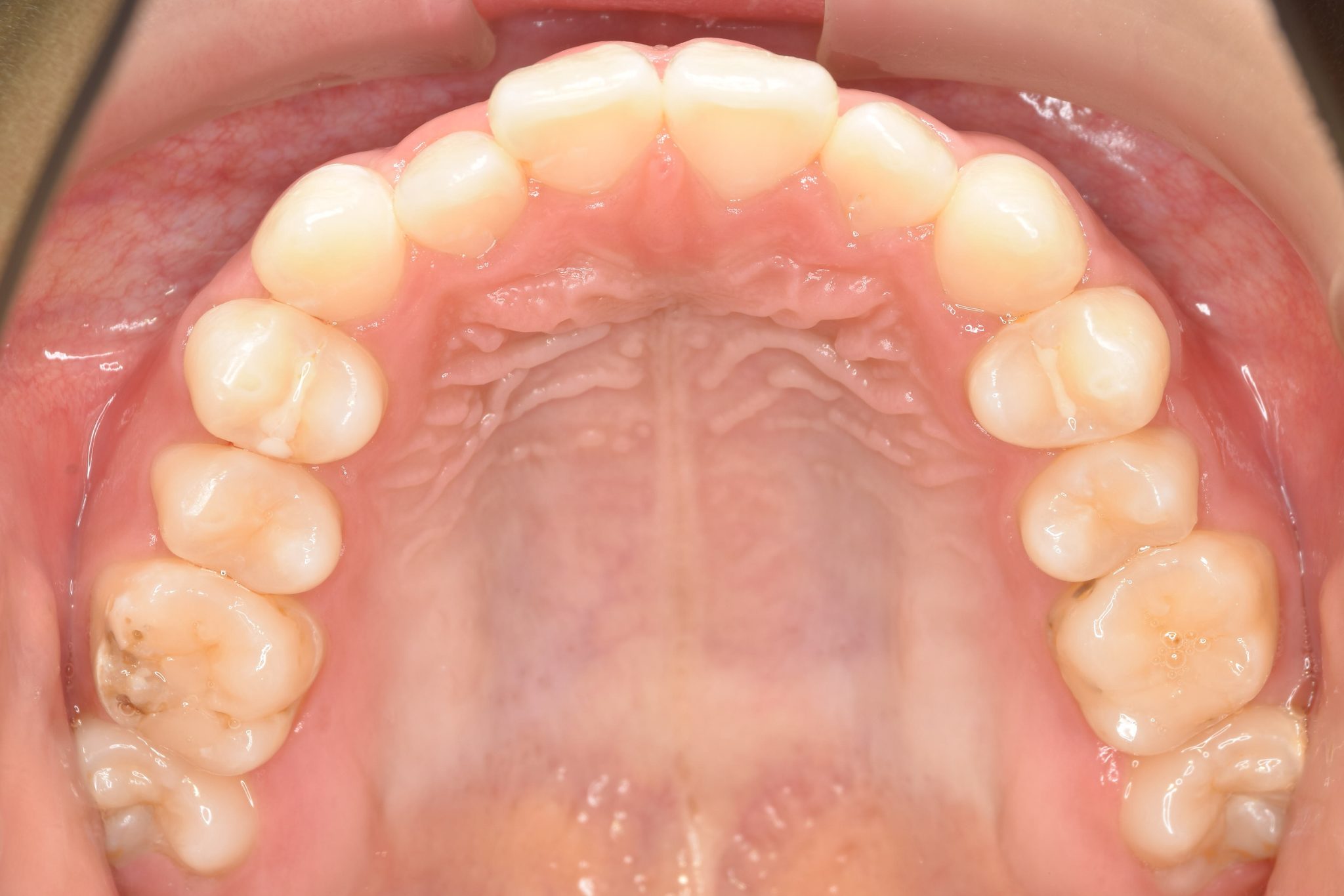 全顎ワイヤー矯正　症例_169