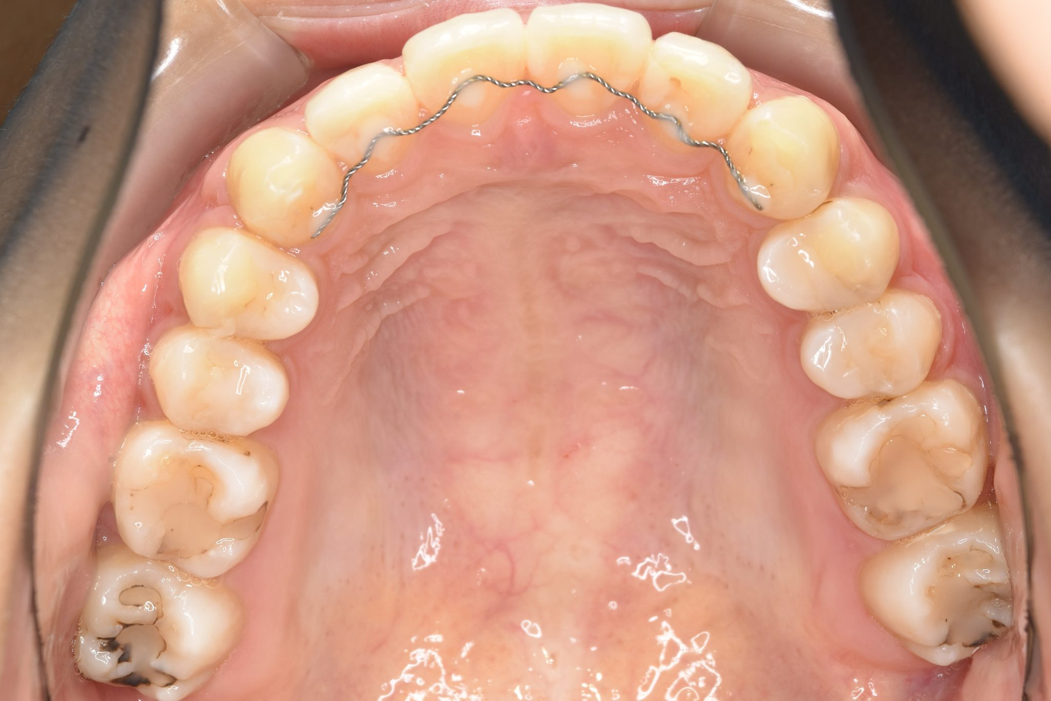 全顎ワイヤー矯正　症例_182