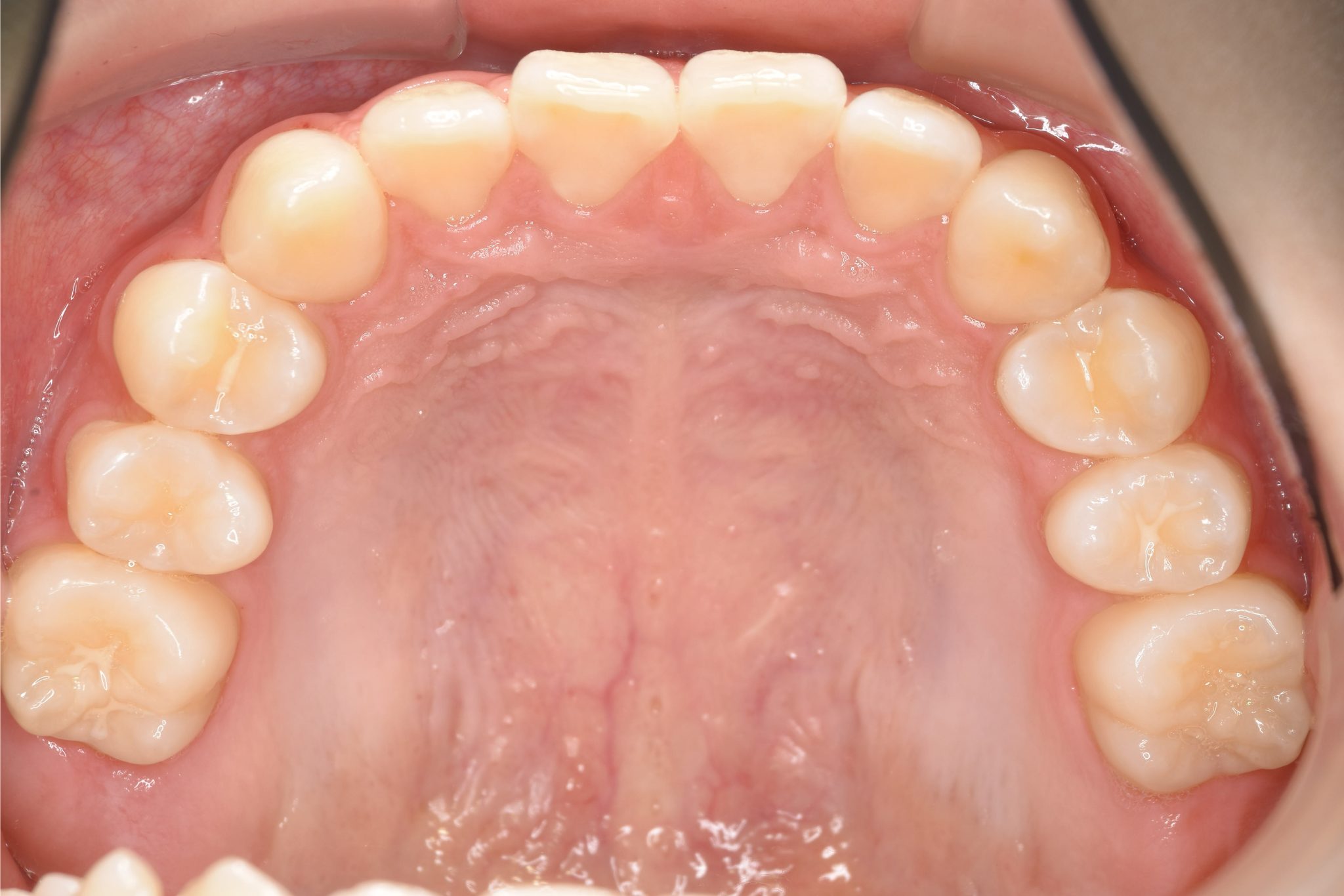 全顎ワイヤー矯正　症例_68