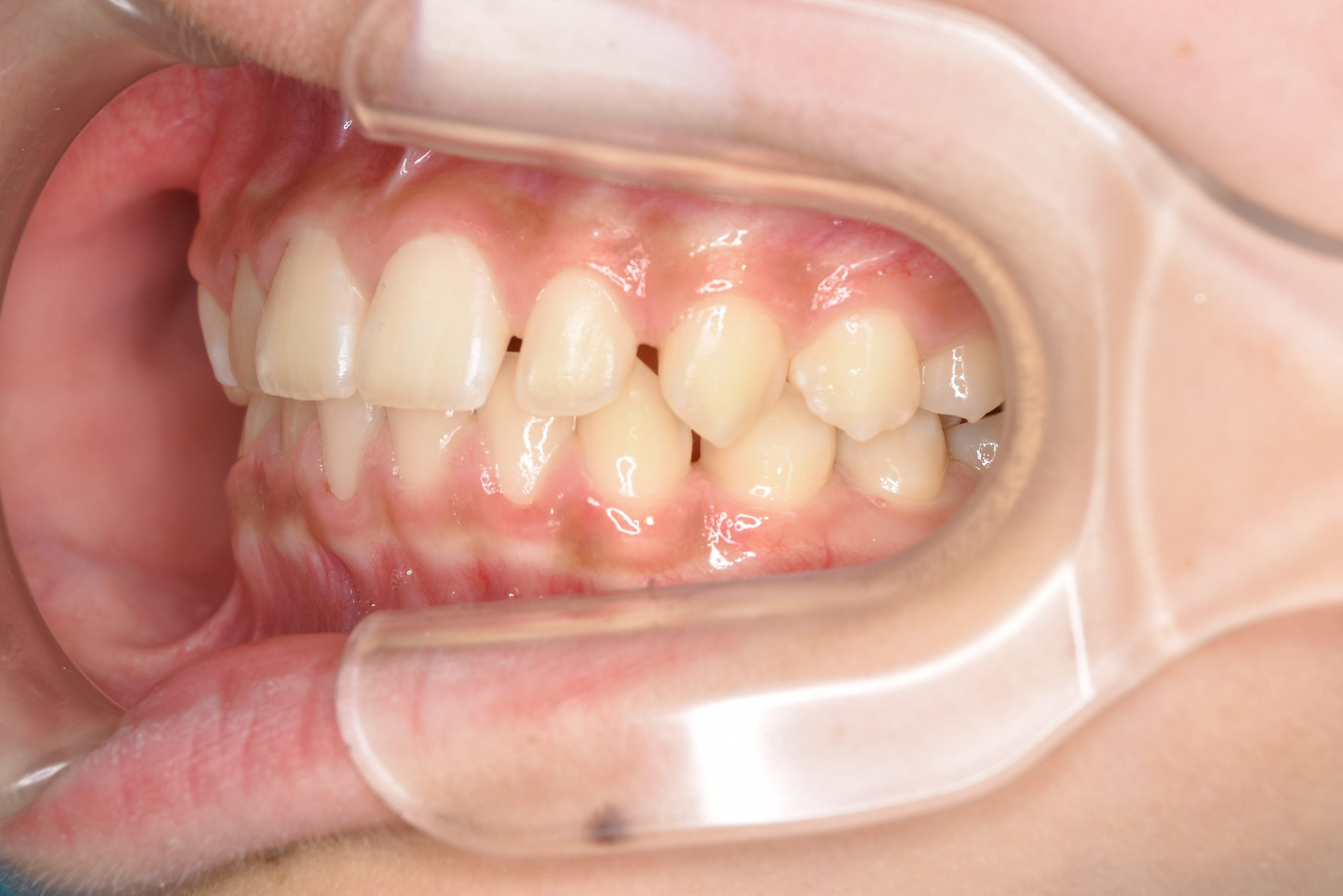 全顎ワイヤー矯正　症例_108