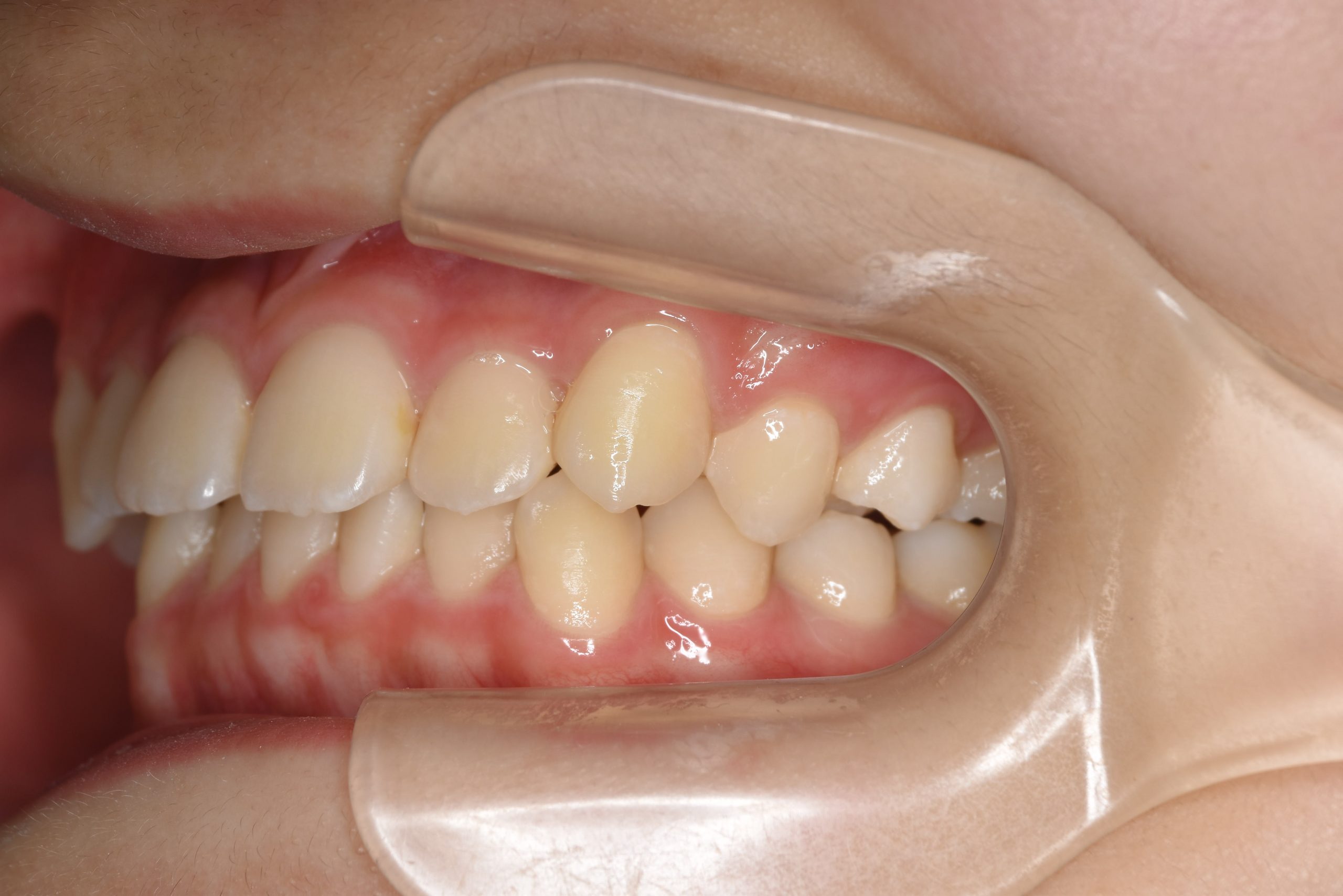 全顎ワイヤー矯正　症例_185