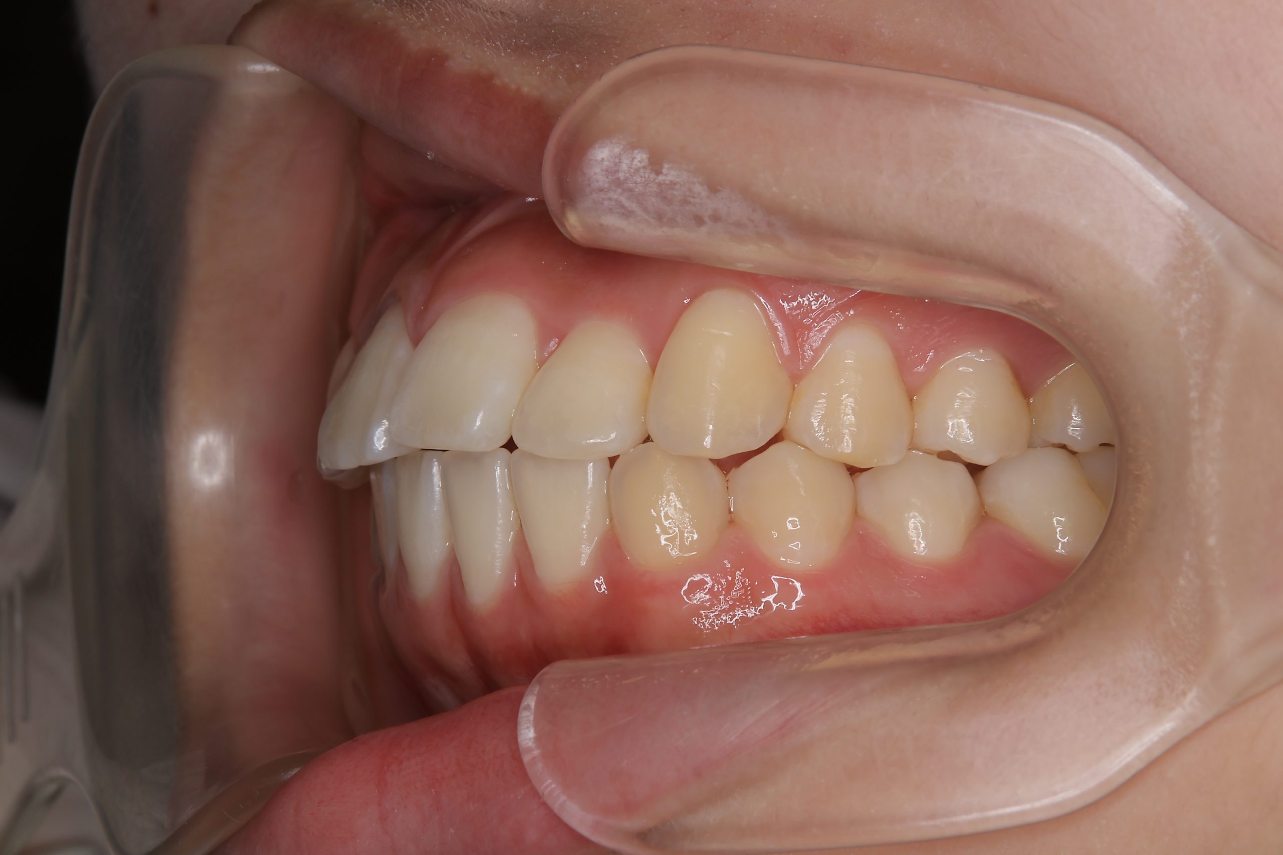 全顎ワイヤー矯正　症例_191