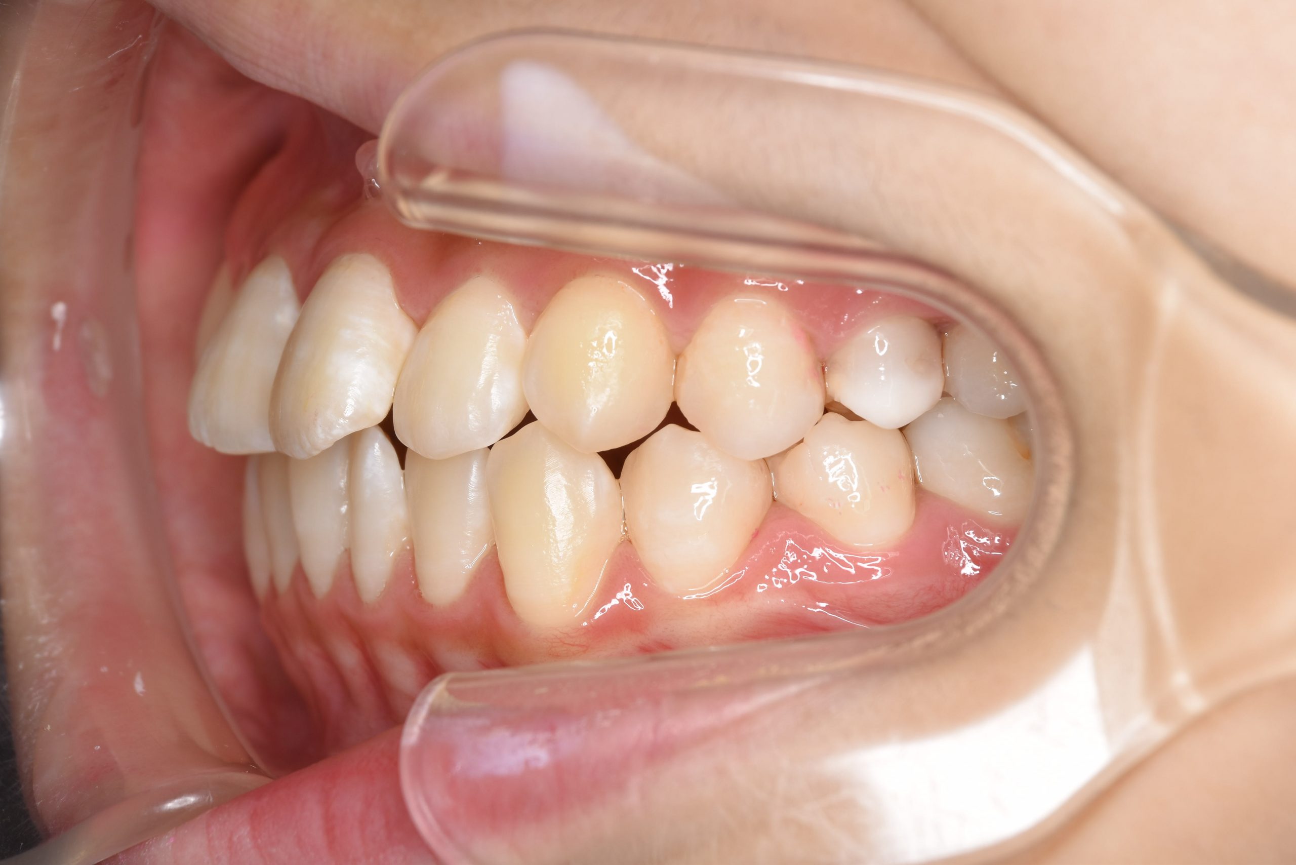 全顎ワイヤー矯正　症例_198