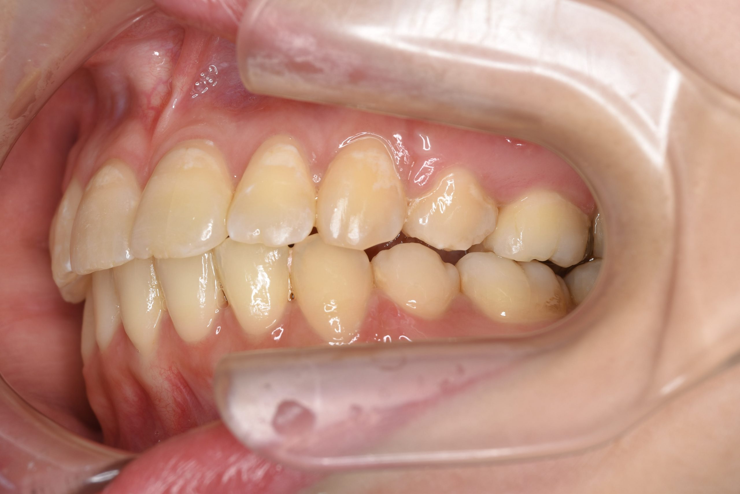 全顎ワイヤー矯正　症例_200