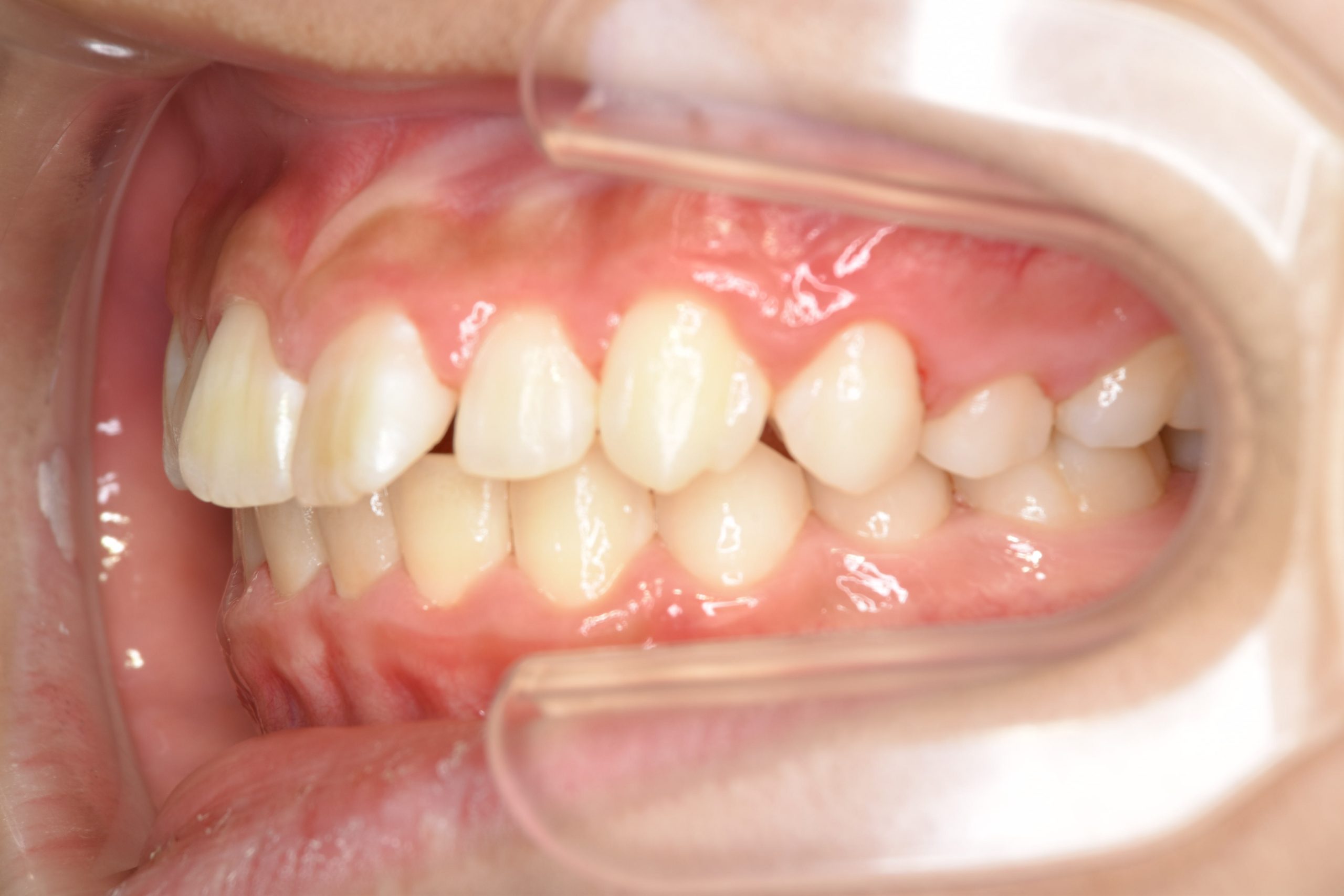 全顎ワイヤー矯正　症例_218