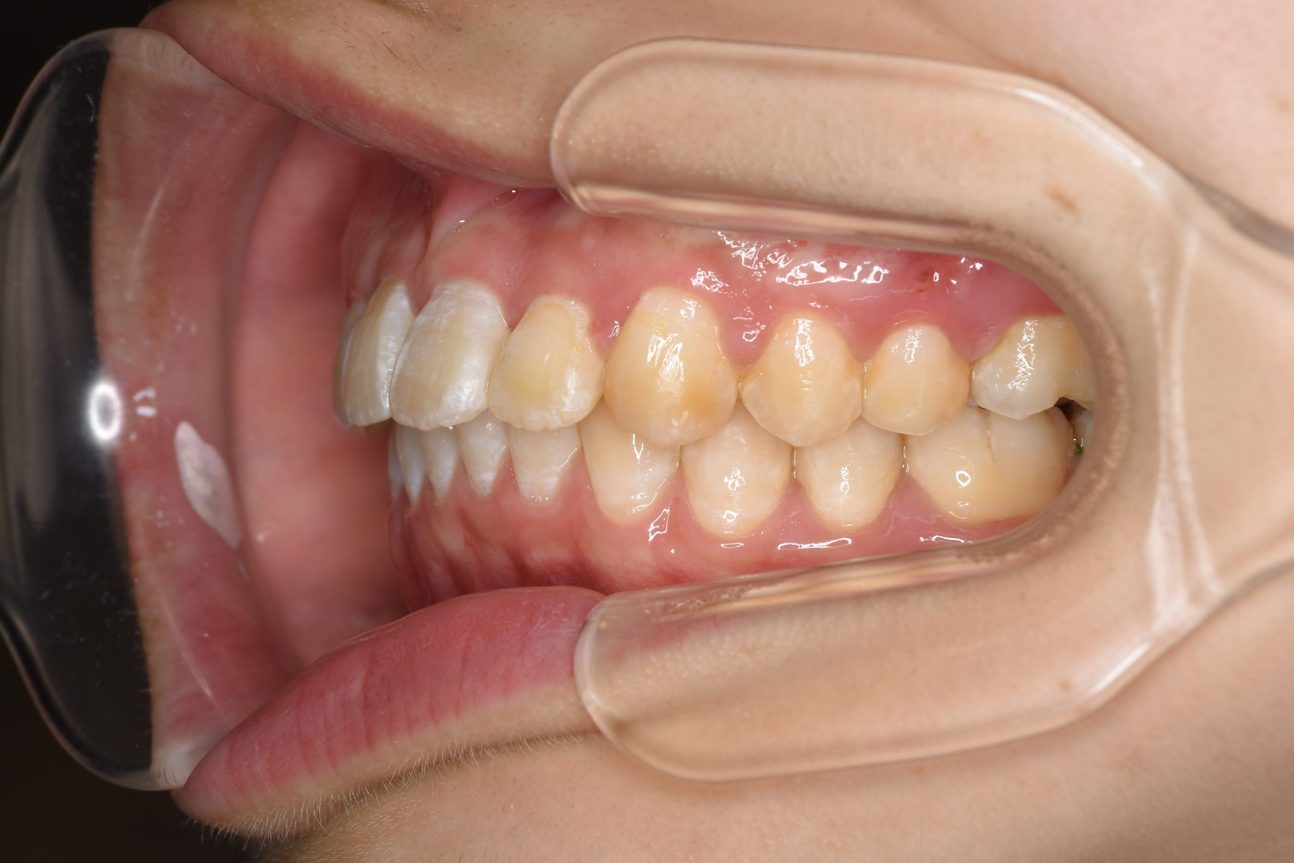 全顎ワイヤー矯正　症例_252