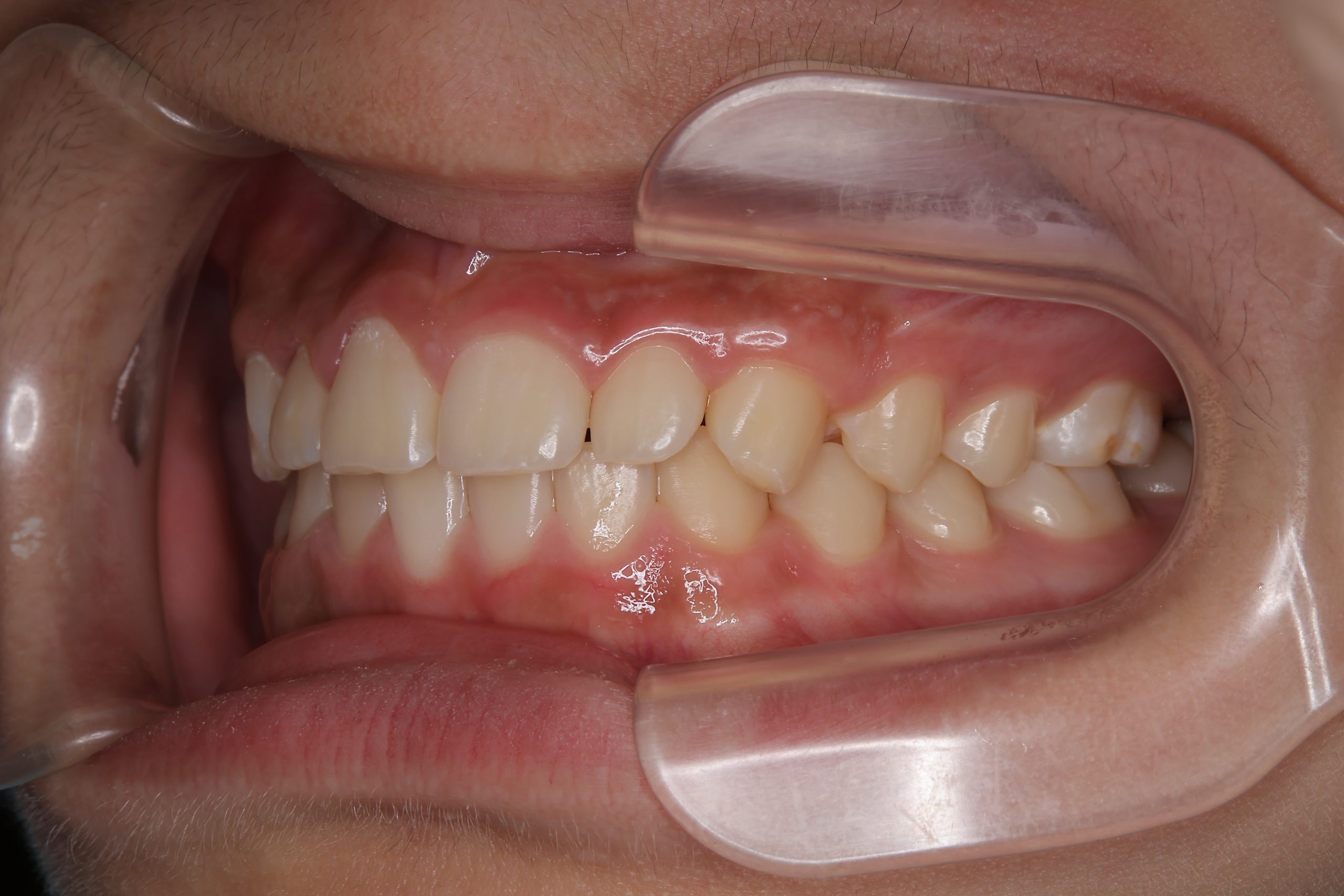 全顎ワイヤー矯正　症例_261