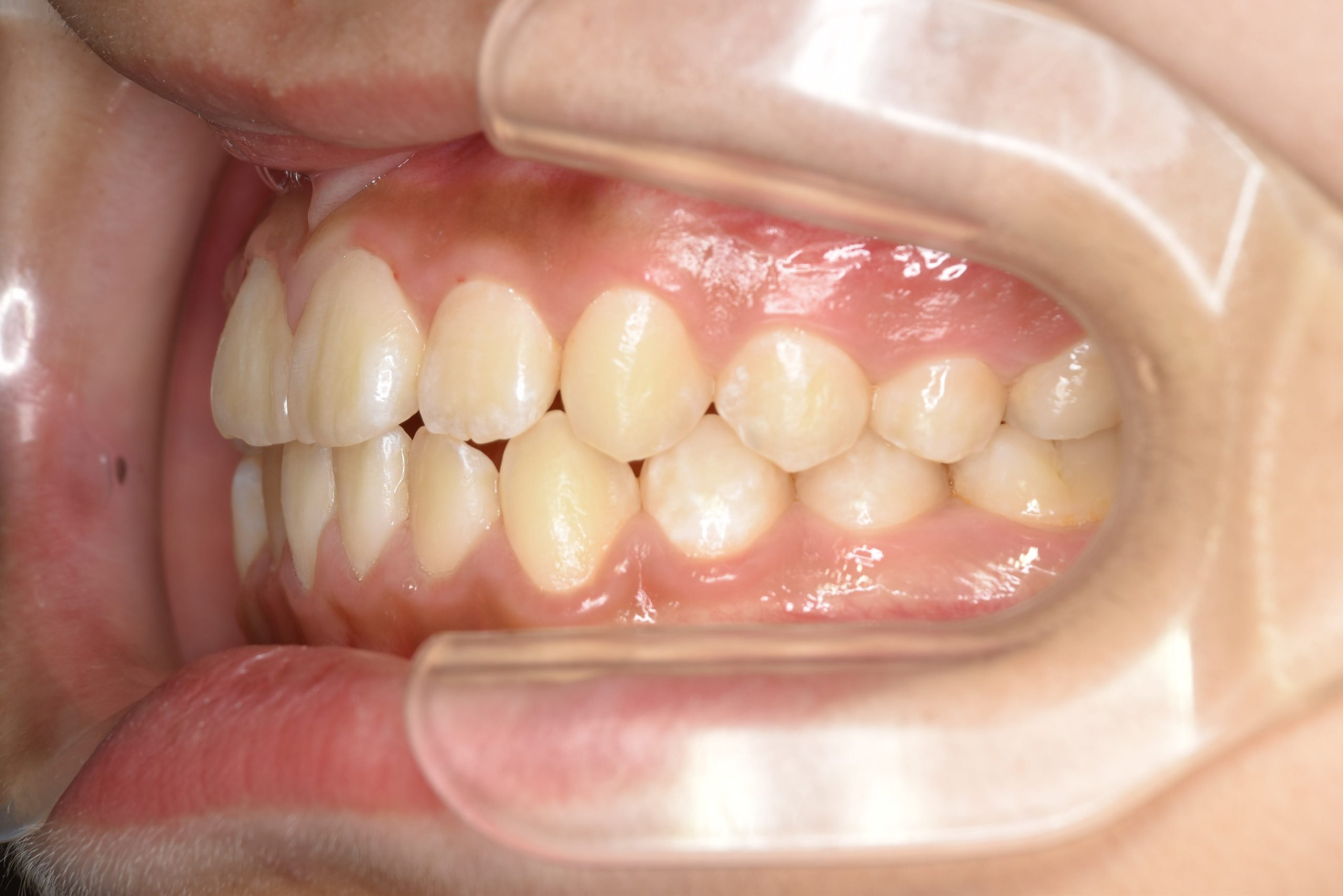 全顎ワイヤー矯正　症例_267