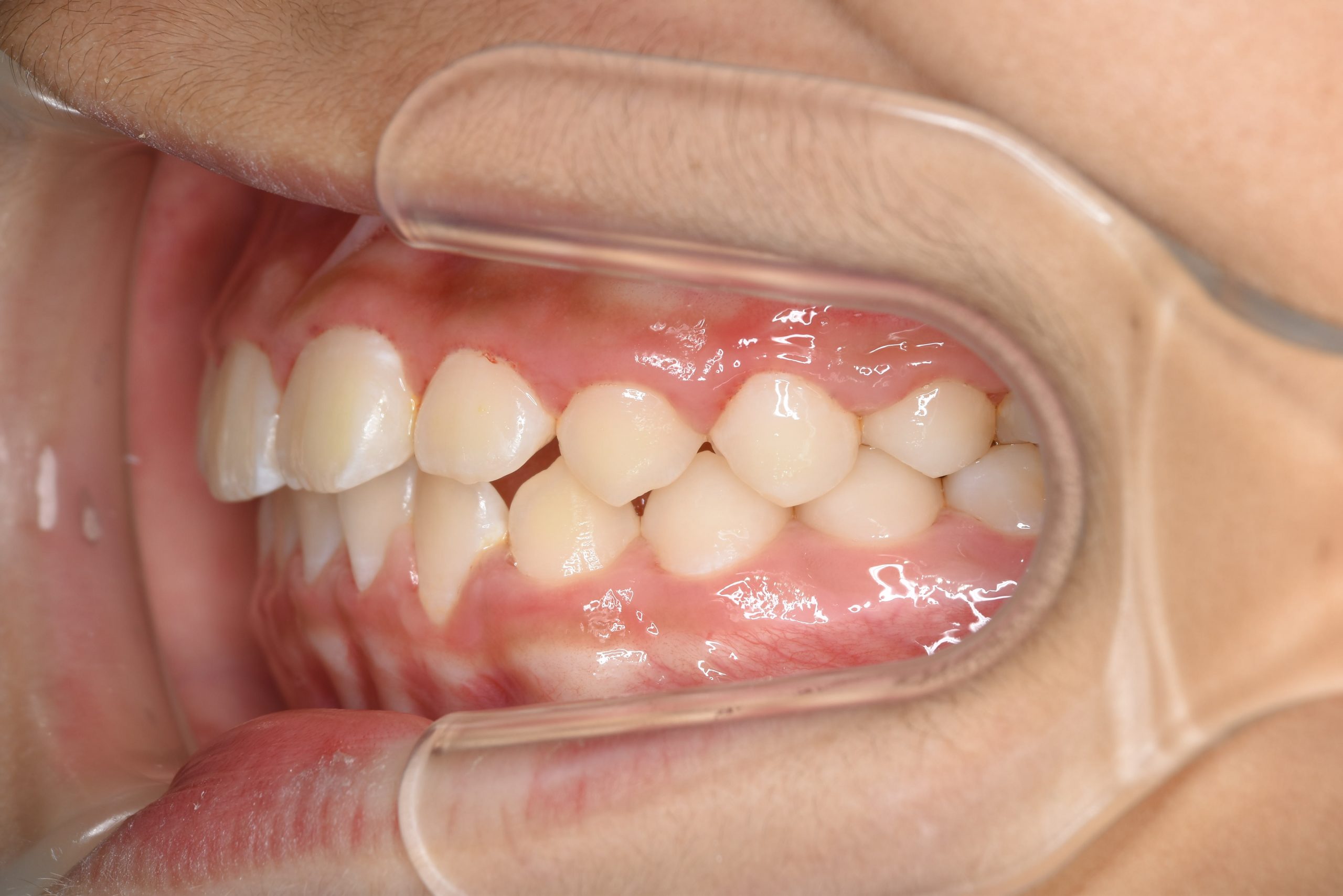 全顎ワイヤー矯正　症例_276