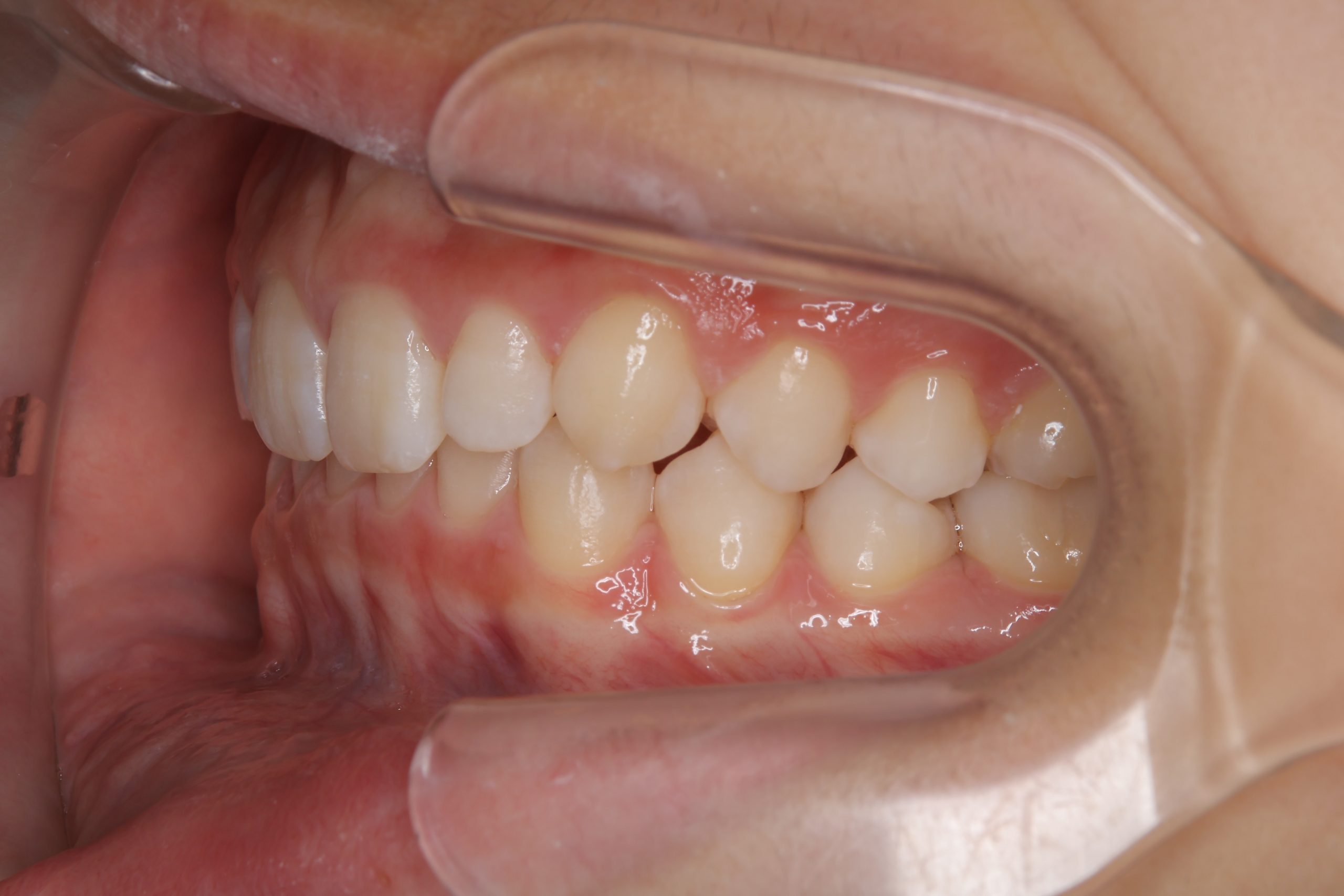 全顎ワイヤー矯正　症例_121