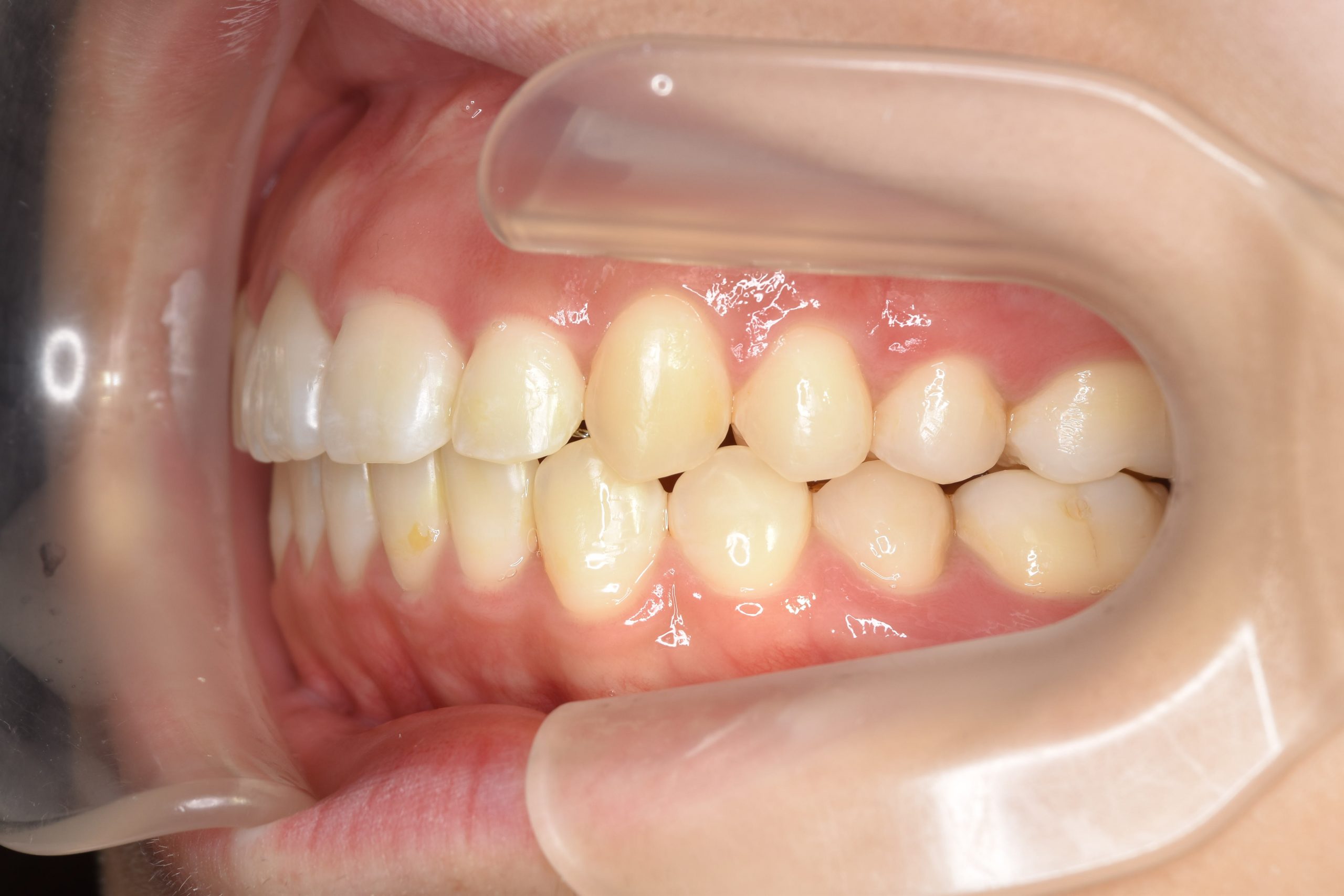 全顎ワイヤー矯正　症例_306