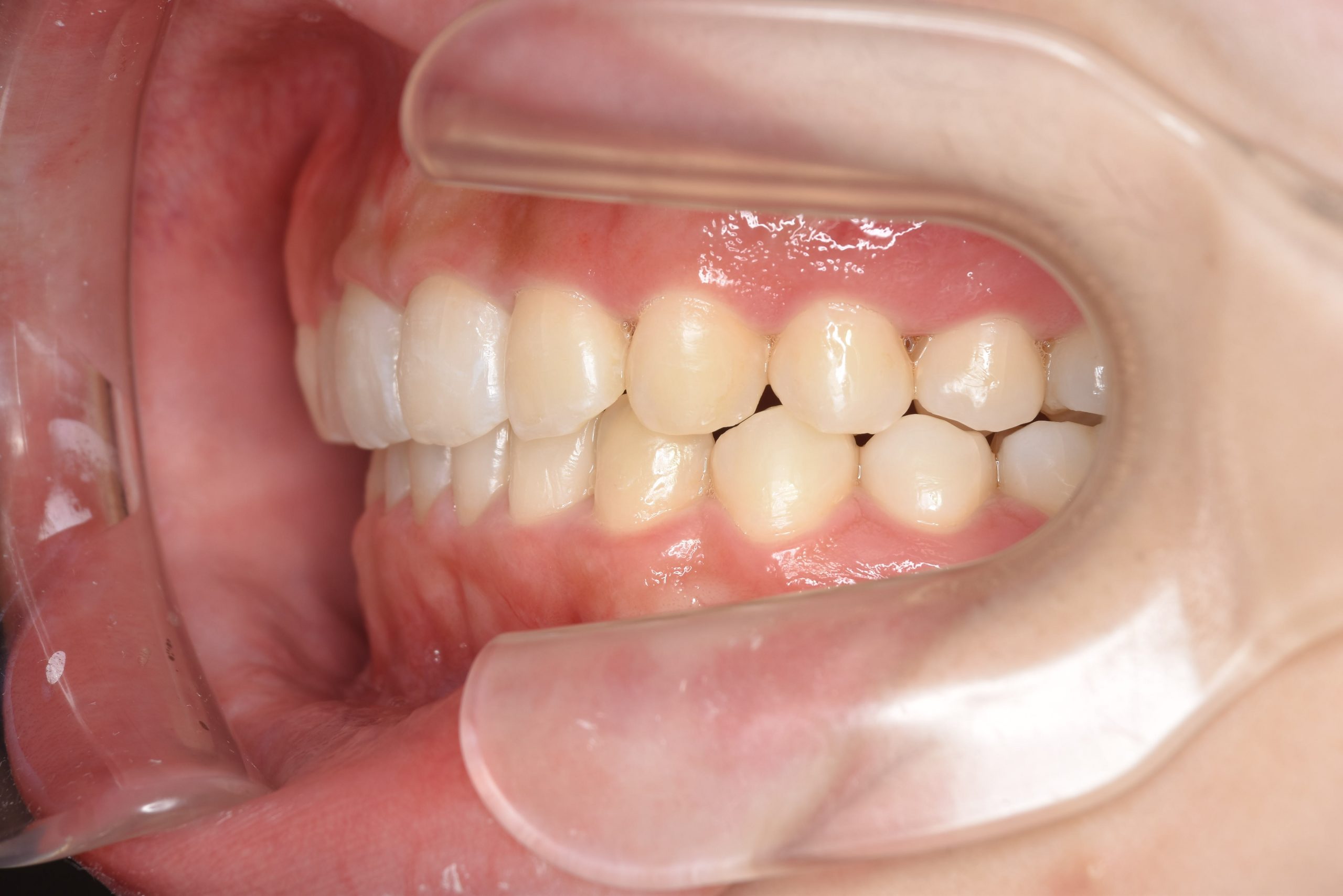 全顎ワイヤー矯正　症例_315