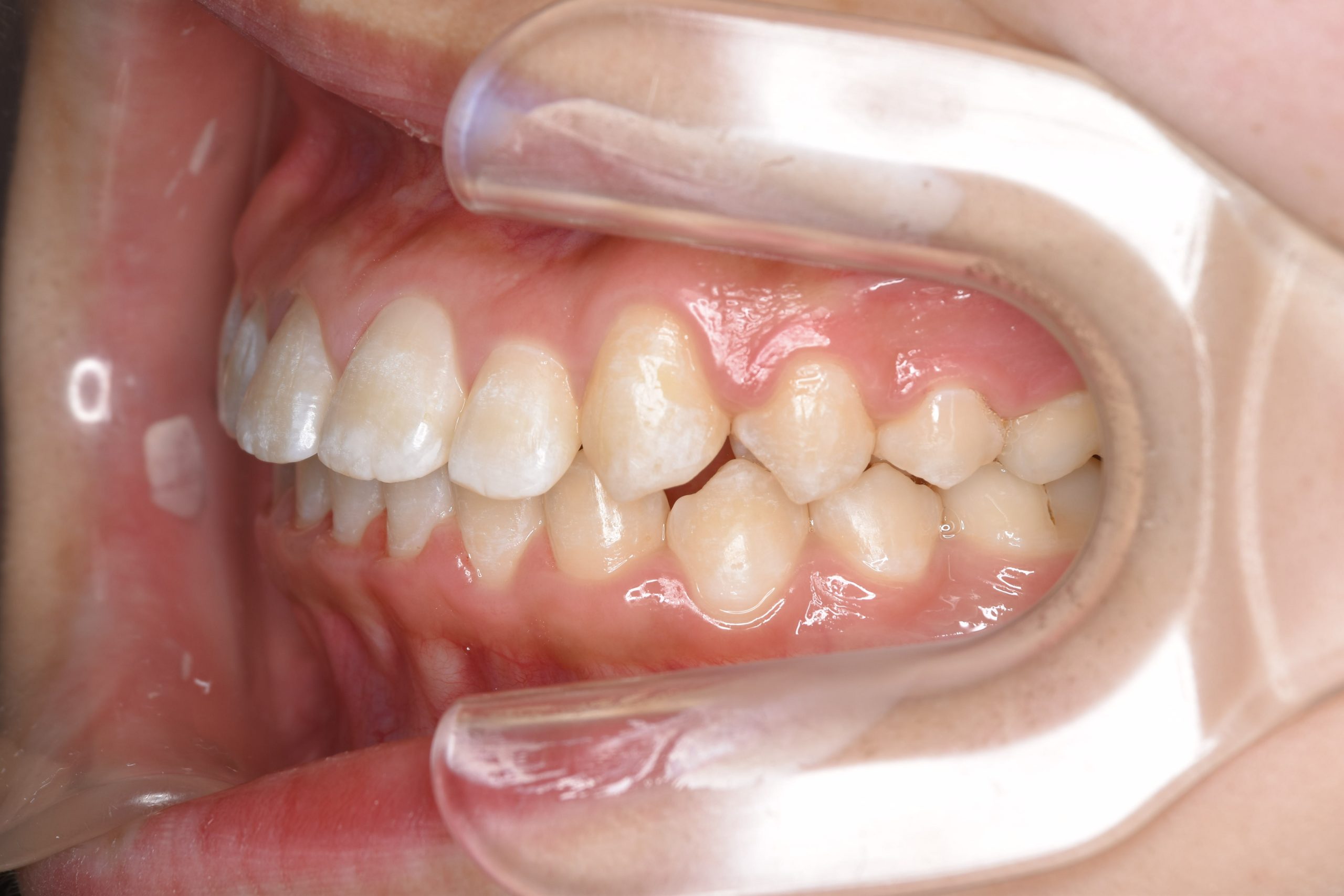 全顎ワイヤー矯正　症例_320