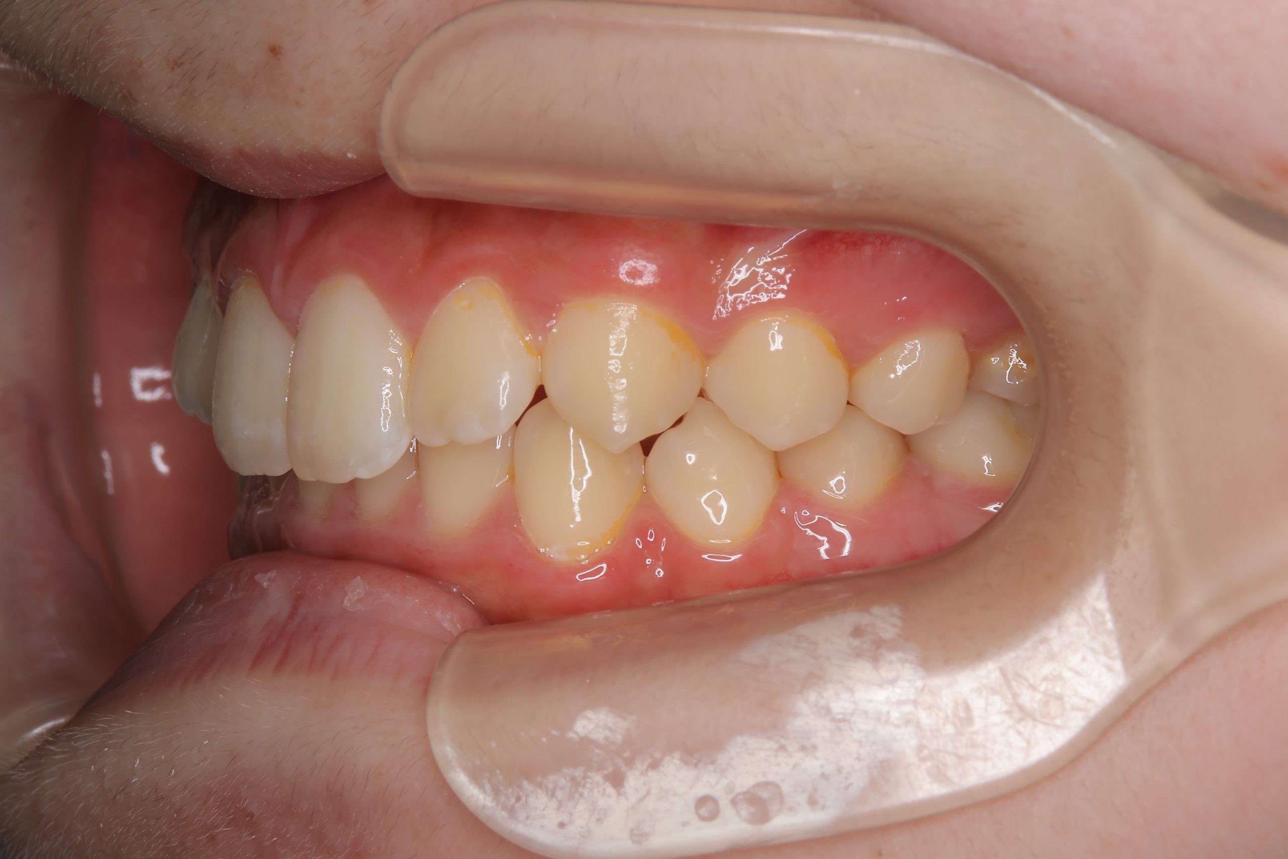 全顎ワイヤー矯正　症例_347