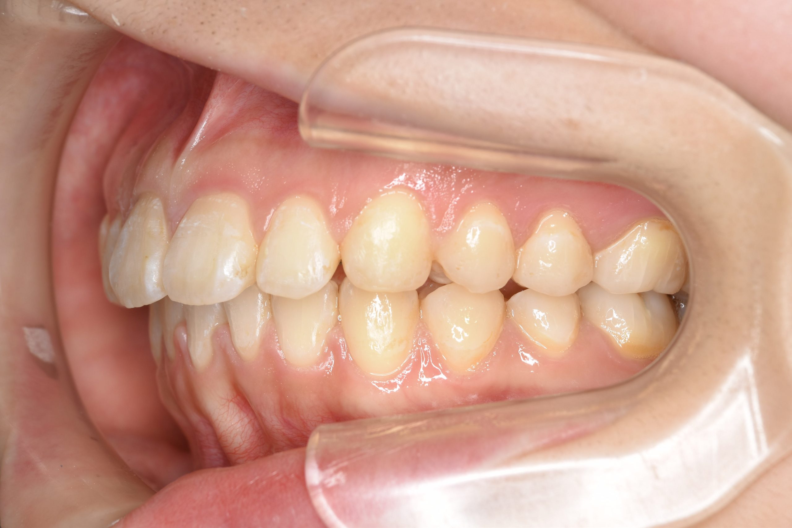 全顎ワイヤー矯正　症例_349