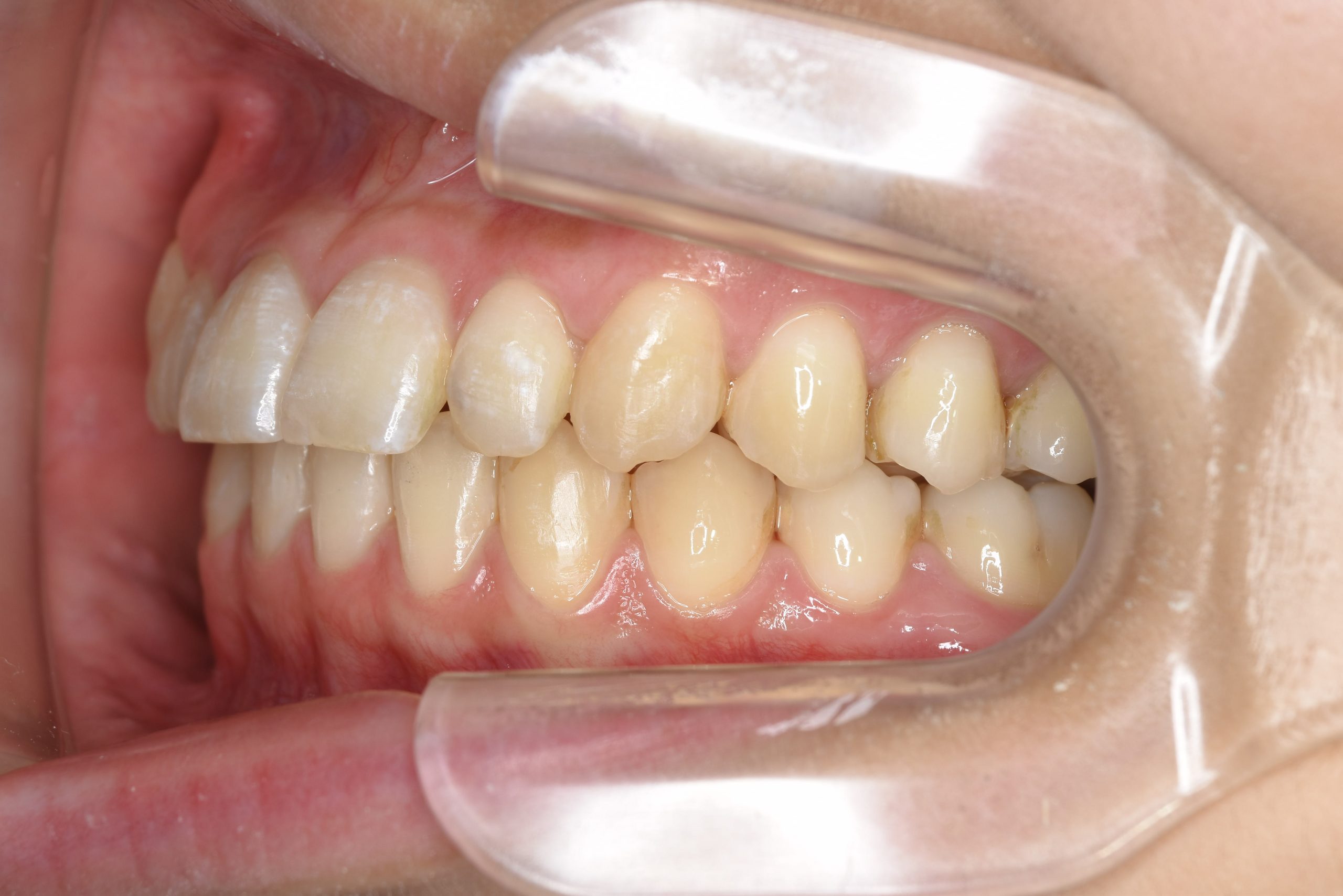 全顎ワイヤー矯正　症例_401