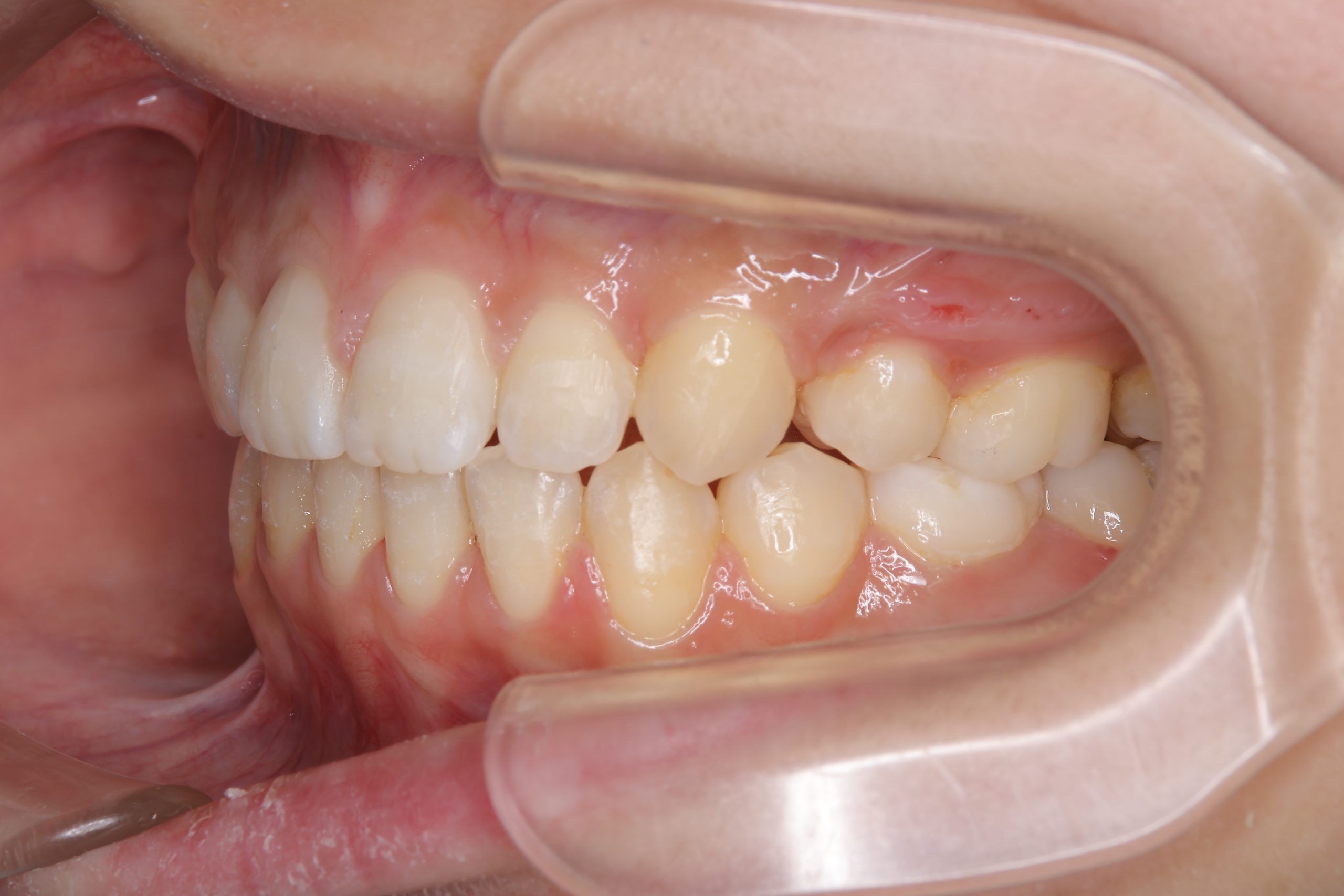 全顎ワイヤー矯正　症例_418