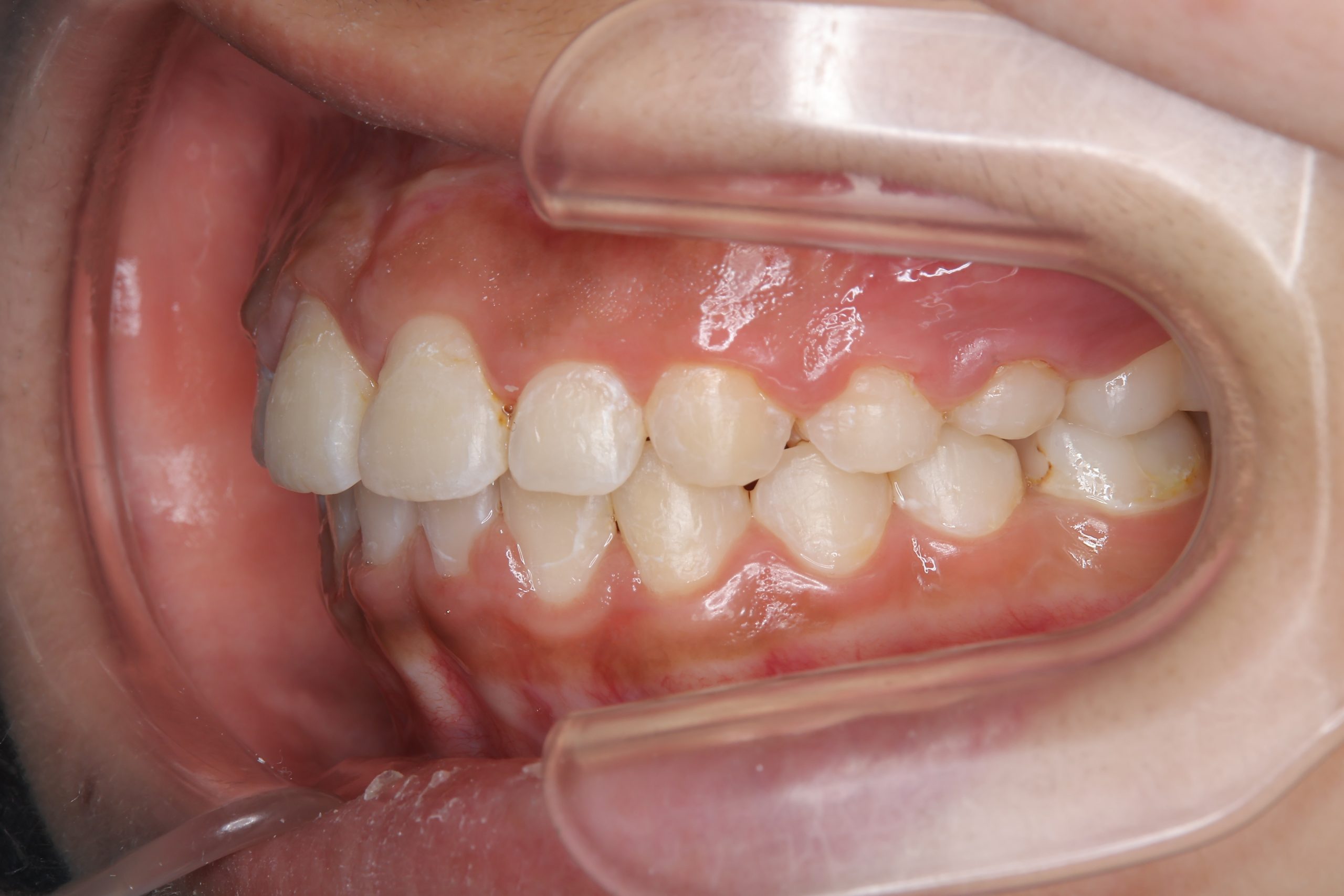 全顎ワイヤー矯正　症例_474