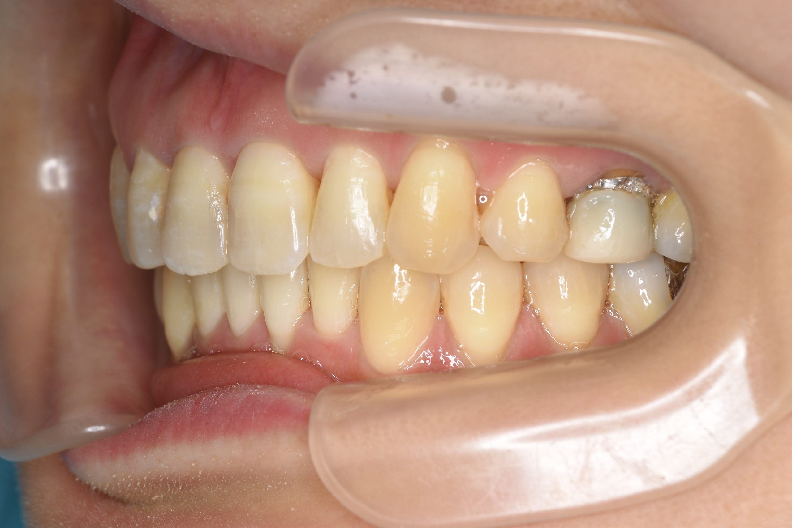 全顎ワイヤー矯正　症例_479