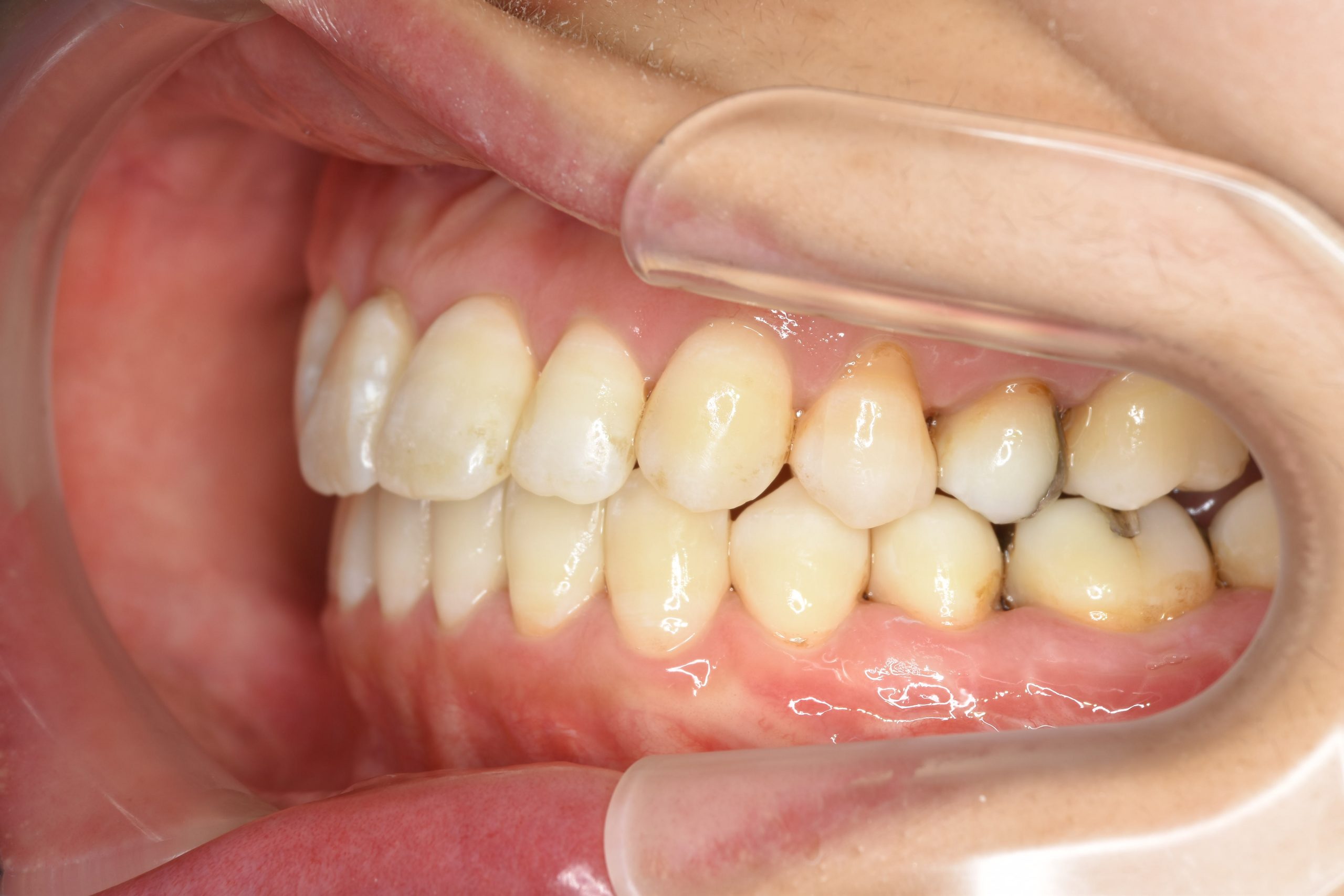 全顎ワイヤー矯正　症例_138