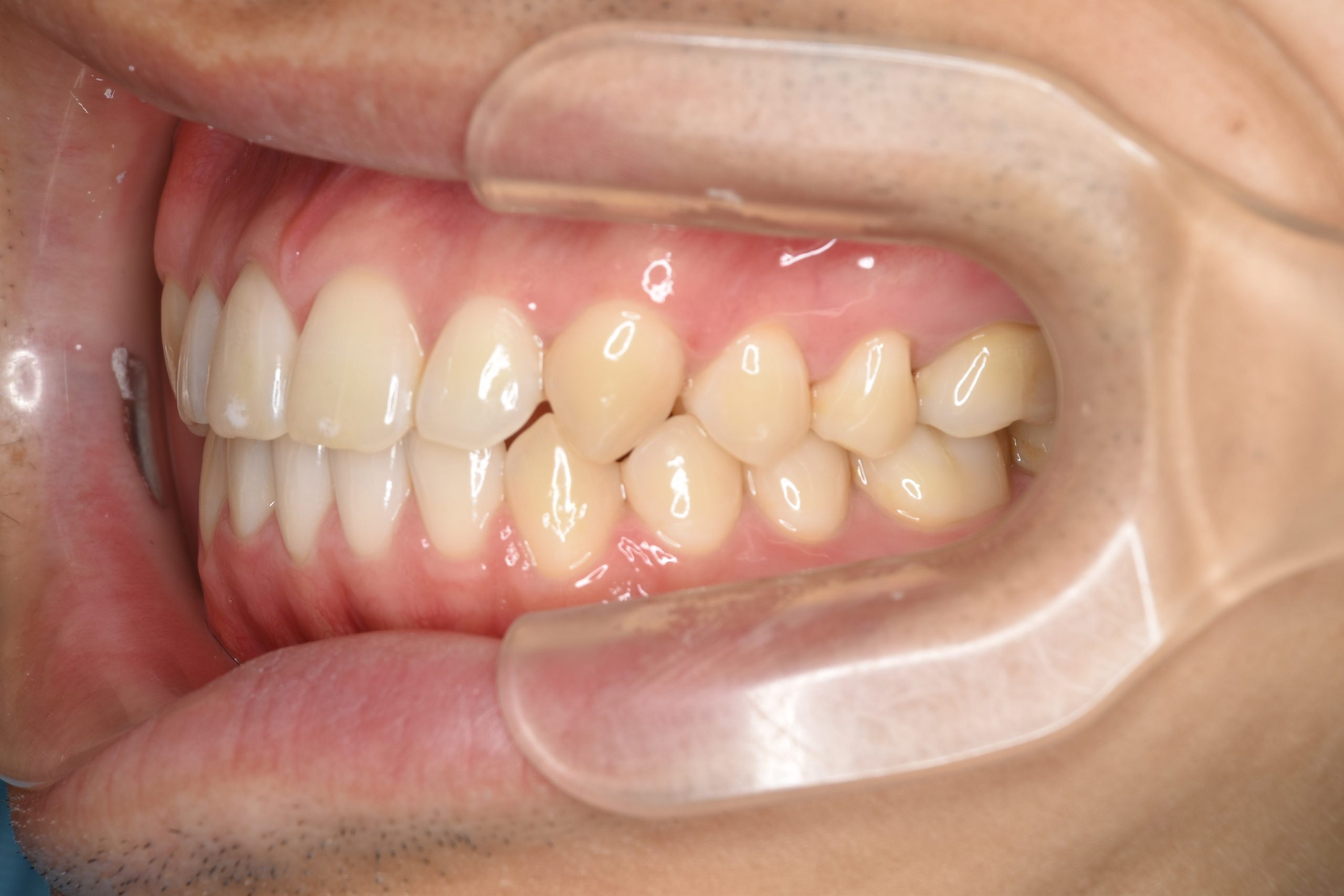 全顎ワイヤー矯正　症例_495