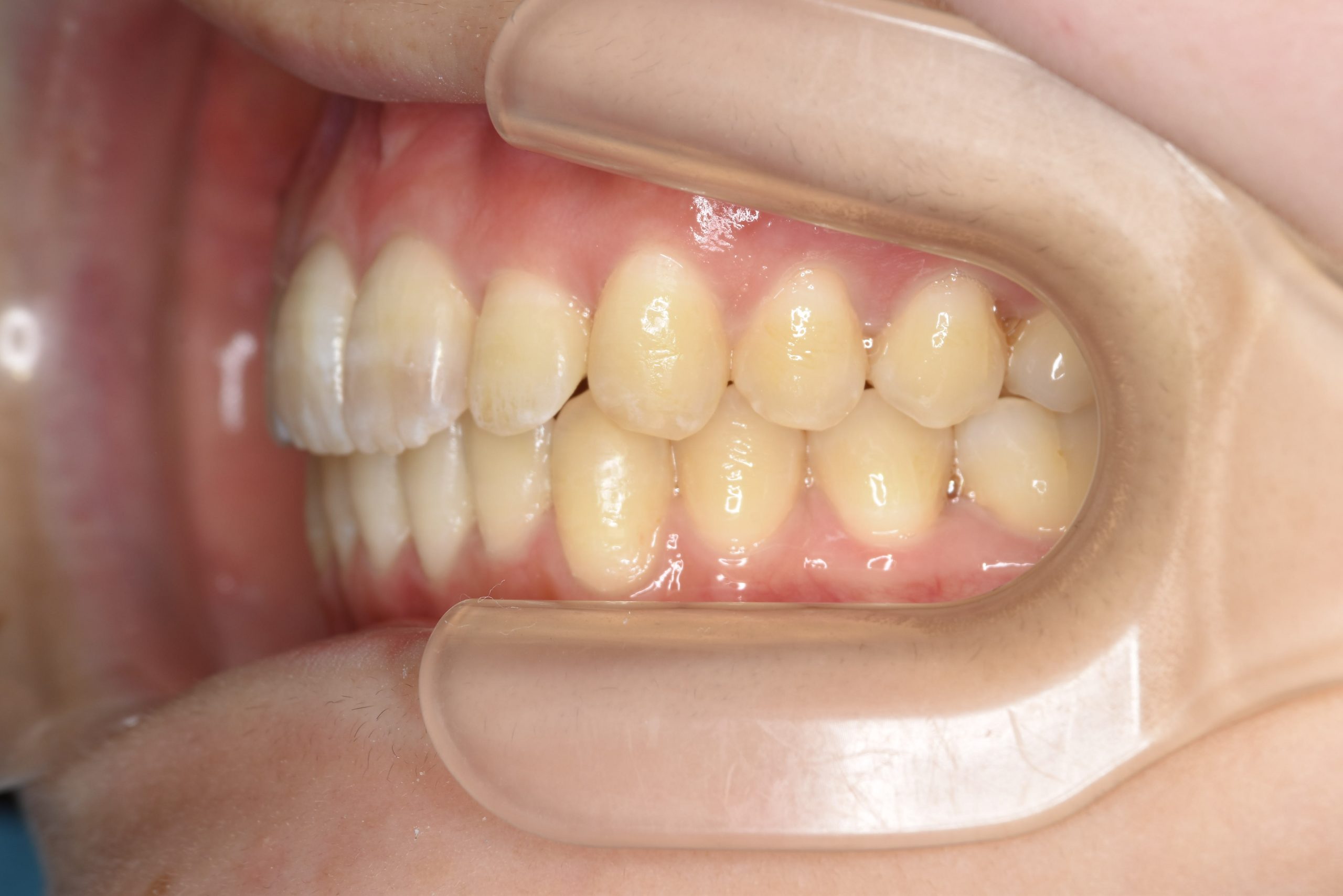 全顎ワイヤー矯正　症例_500