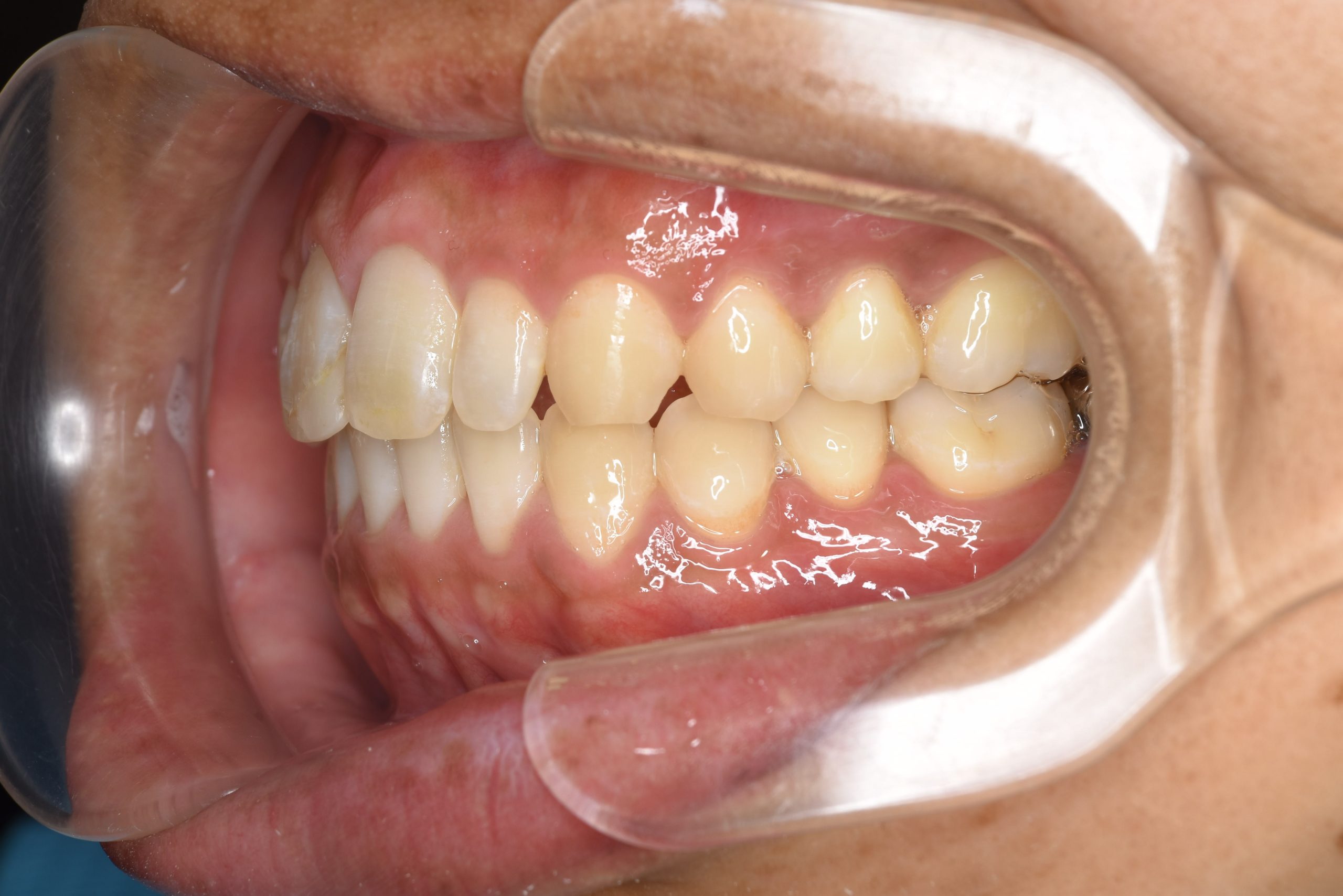 全顎ワイヤー矯正　症例_510