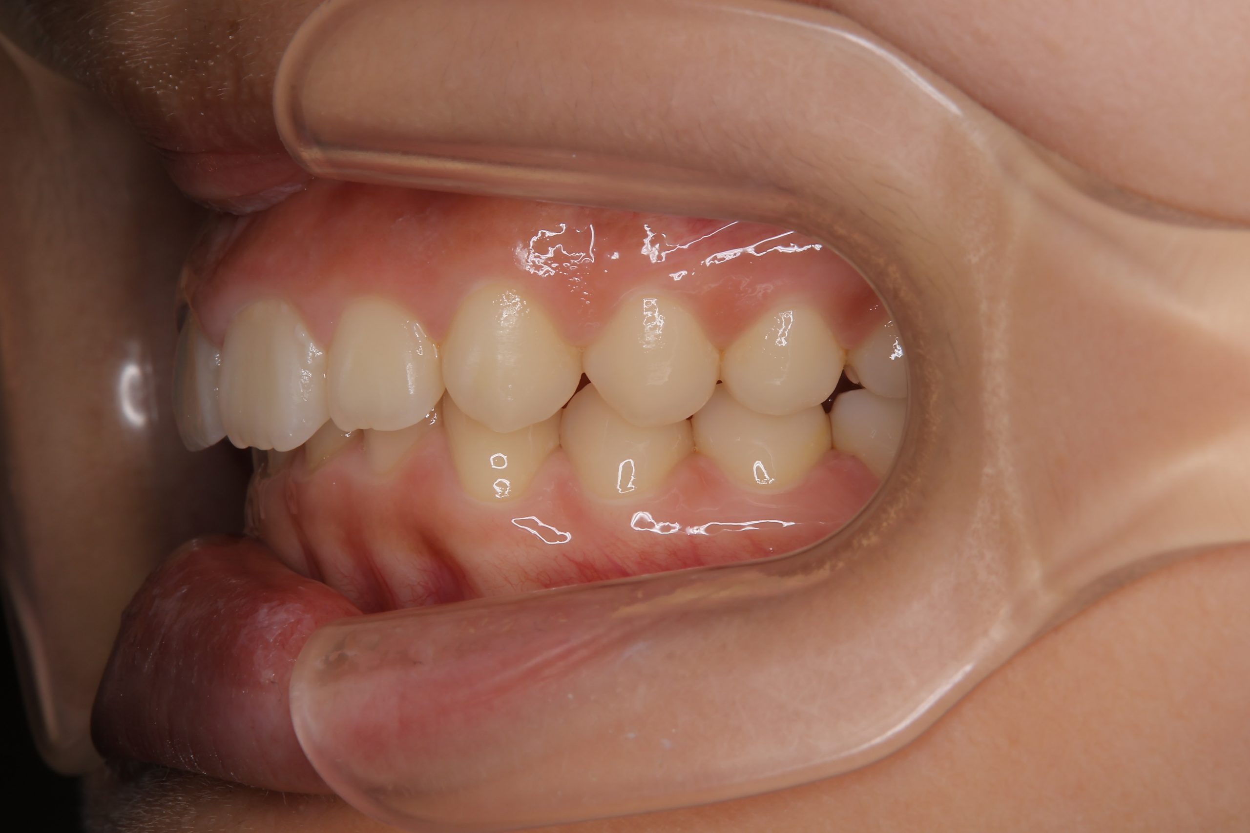 全顎ワイヤー矯正　症例_547