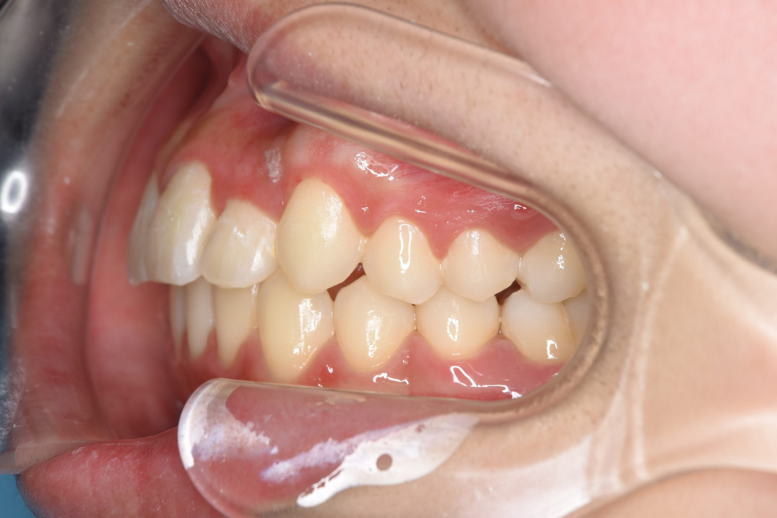 全顎ワイヤー矯正　症例_551