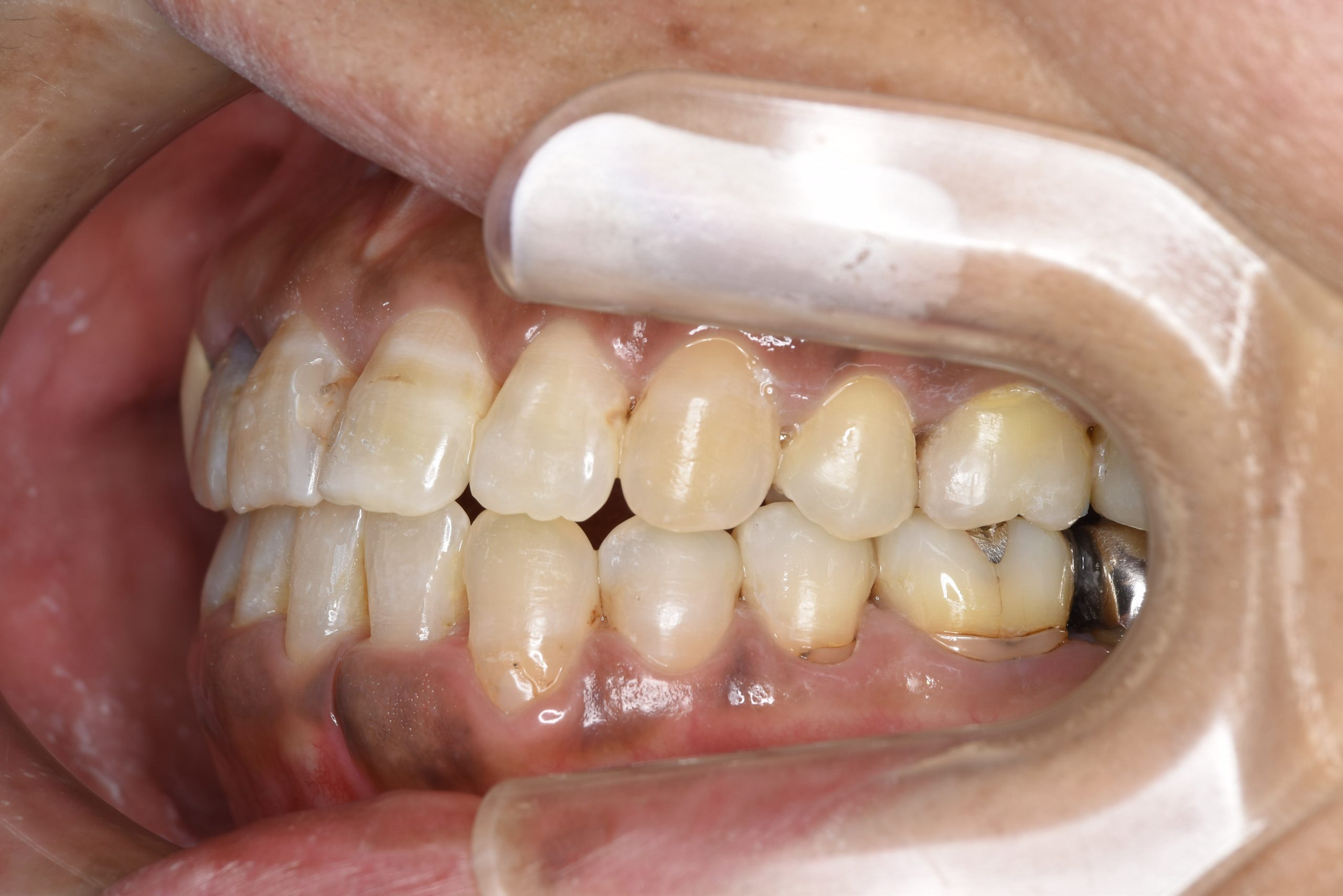 全顎ワイヤー矯正　症例_588