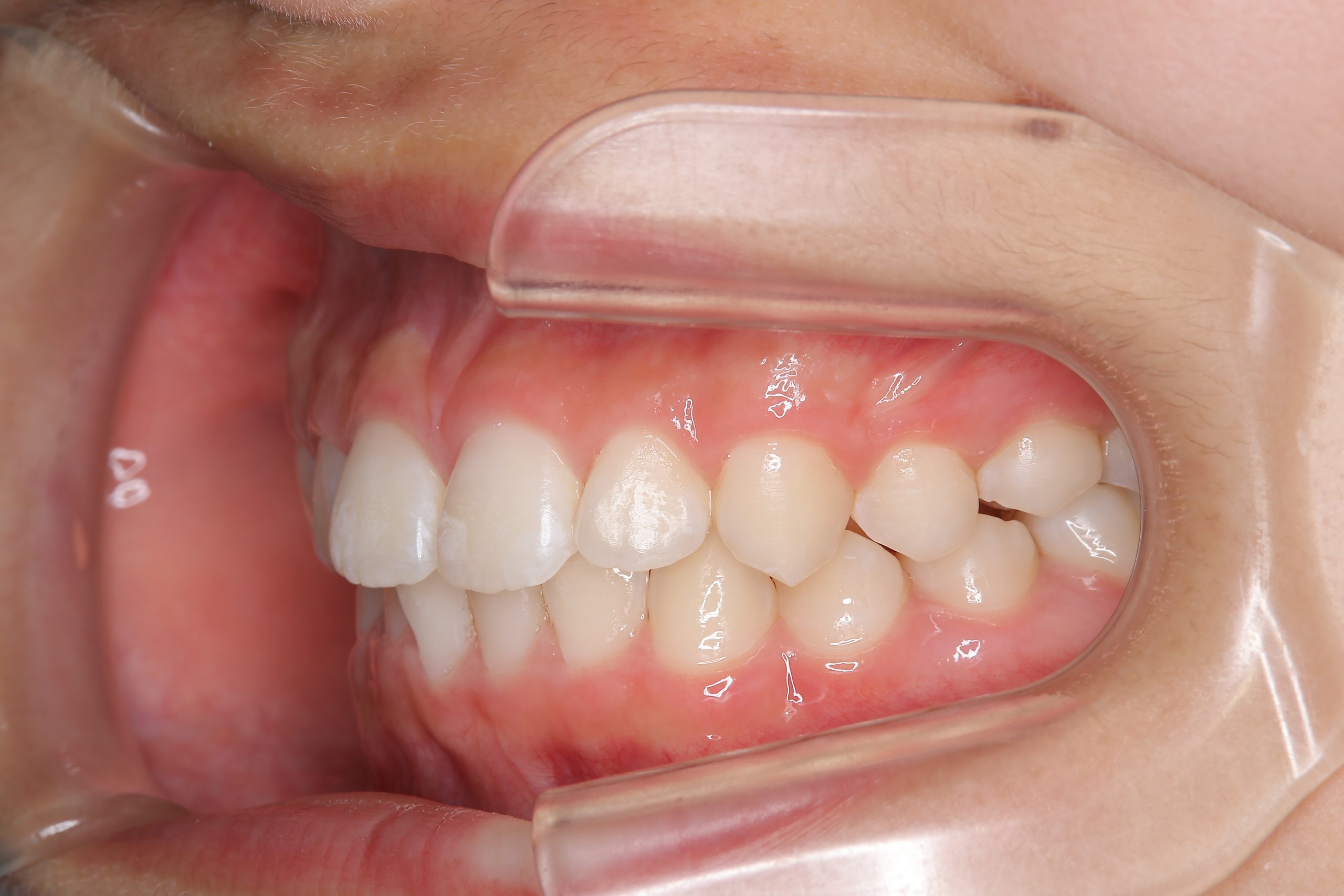 全顎ワイヤー矯正　症例_610