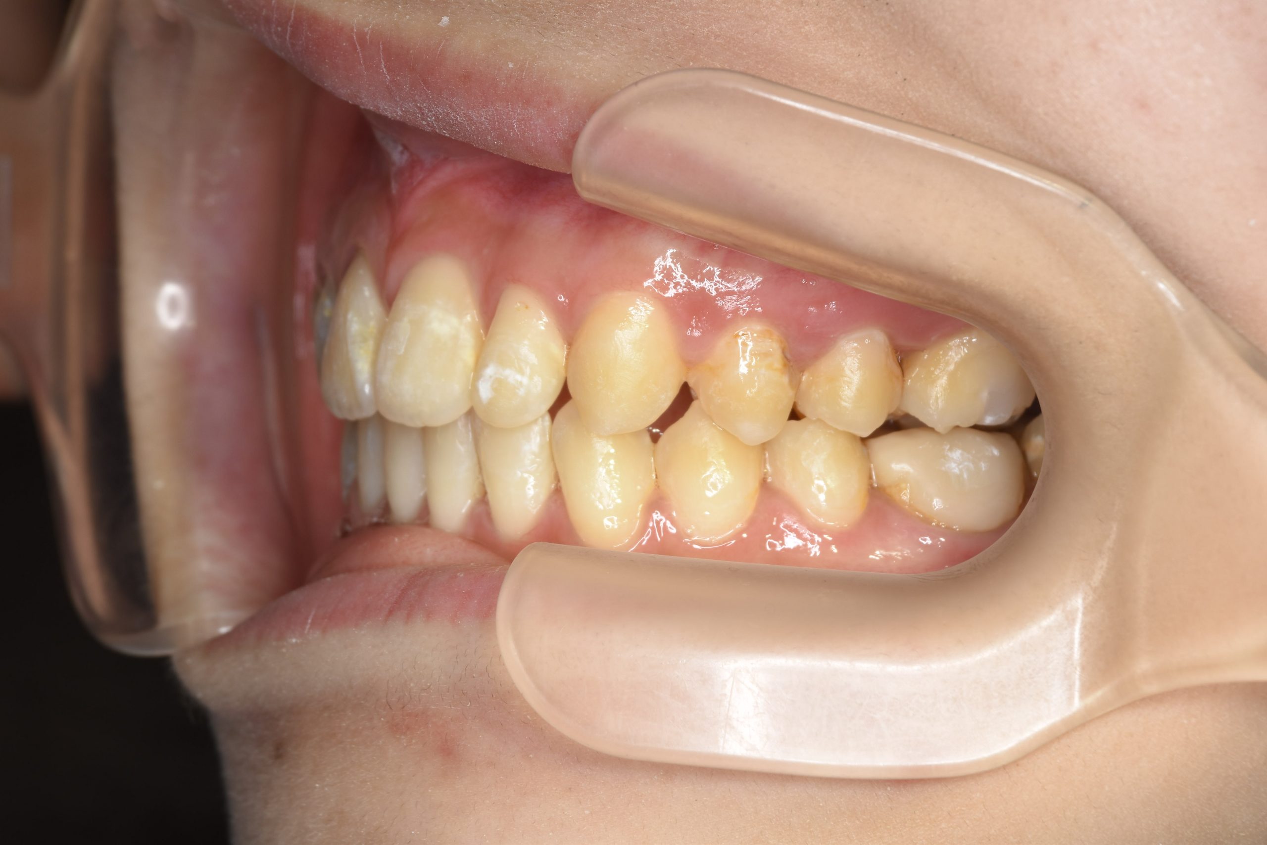 全顎ワイヤー矯正　症例_640