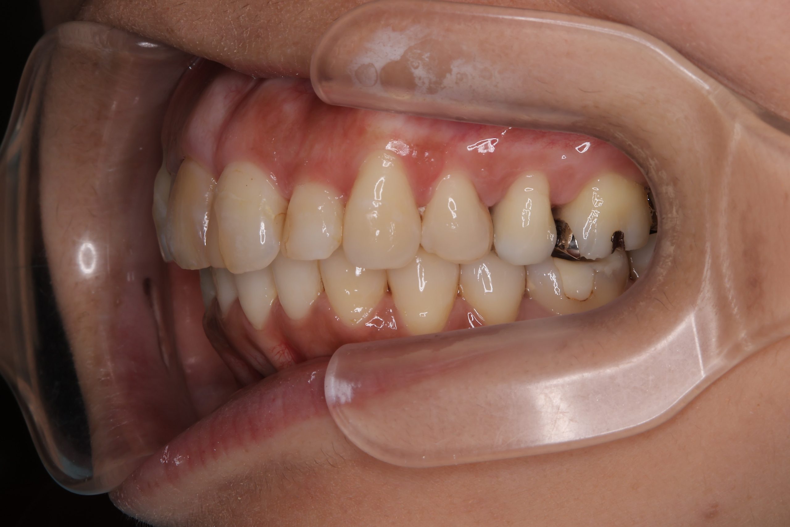 全顎ワイヤー矯正　症例_649