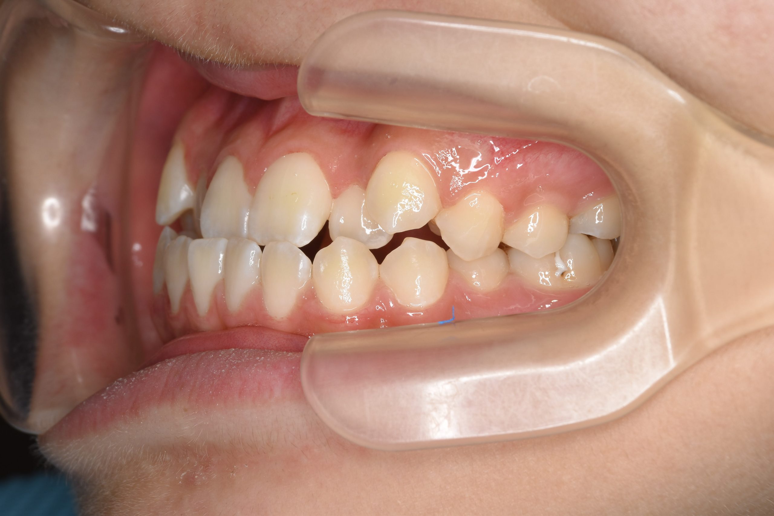 全顎ワイヤー矯正　症例_139