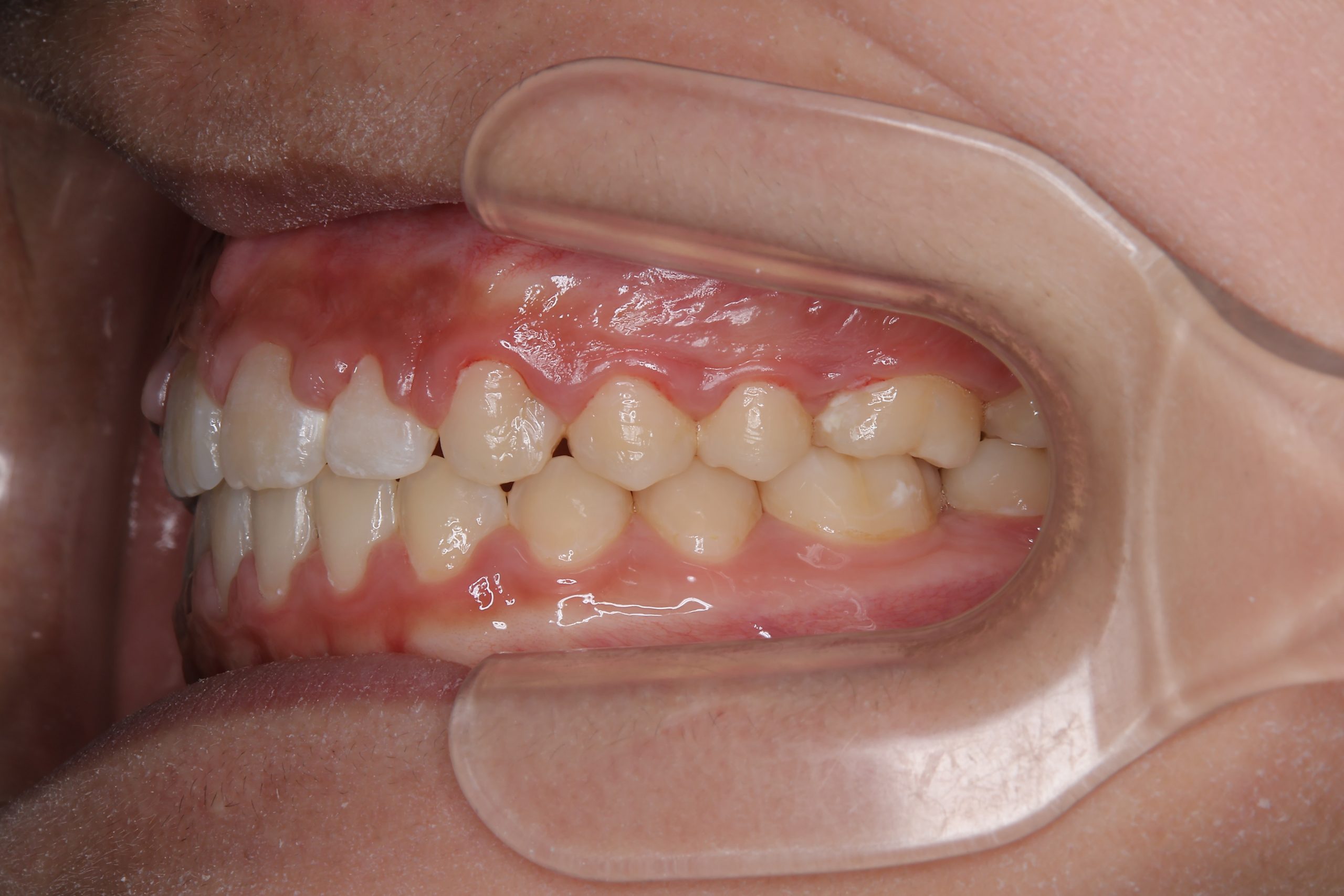 全顎ワイヤー矯正　症例_681