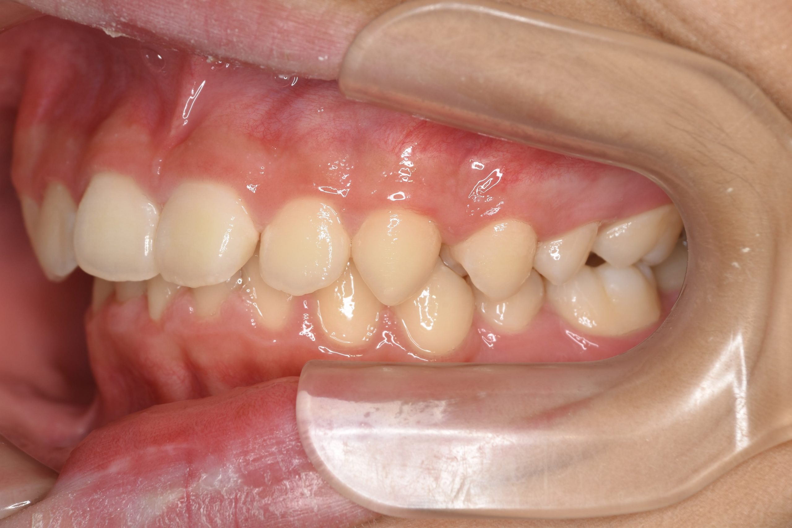 全顎ワイヤー矯正　症例_758