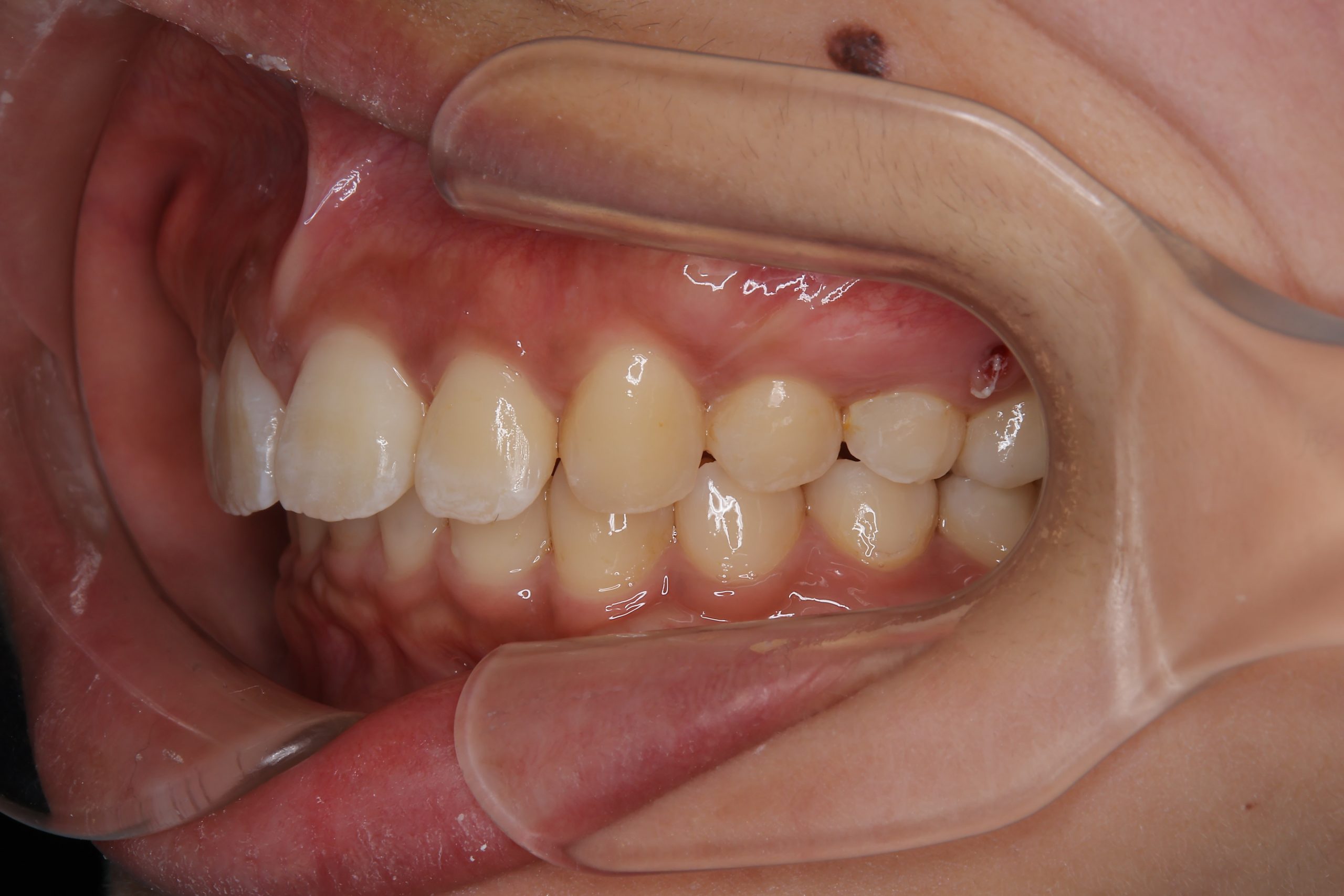 全顎ワイヤー矯正　症例_793