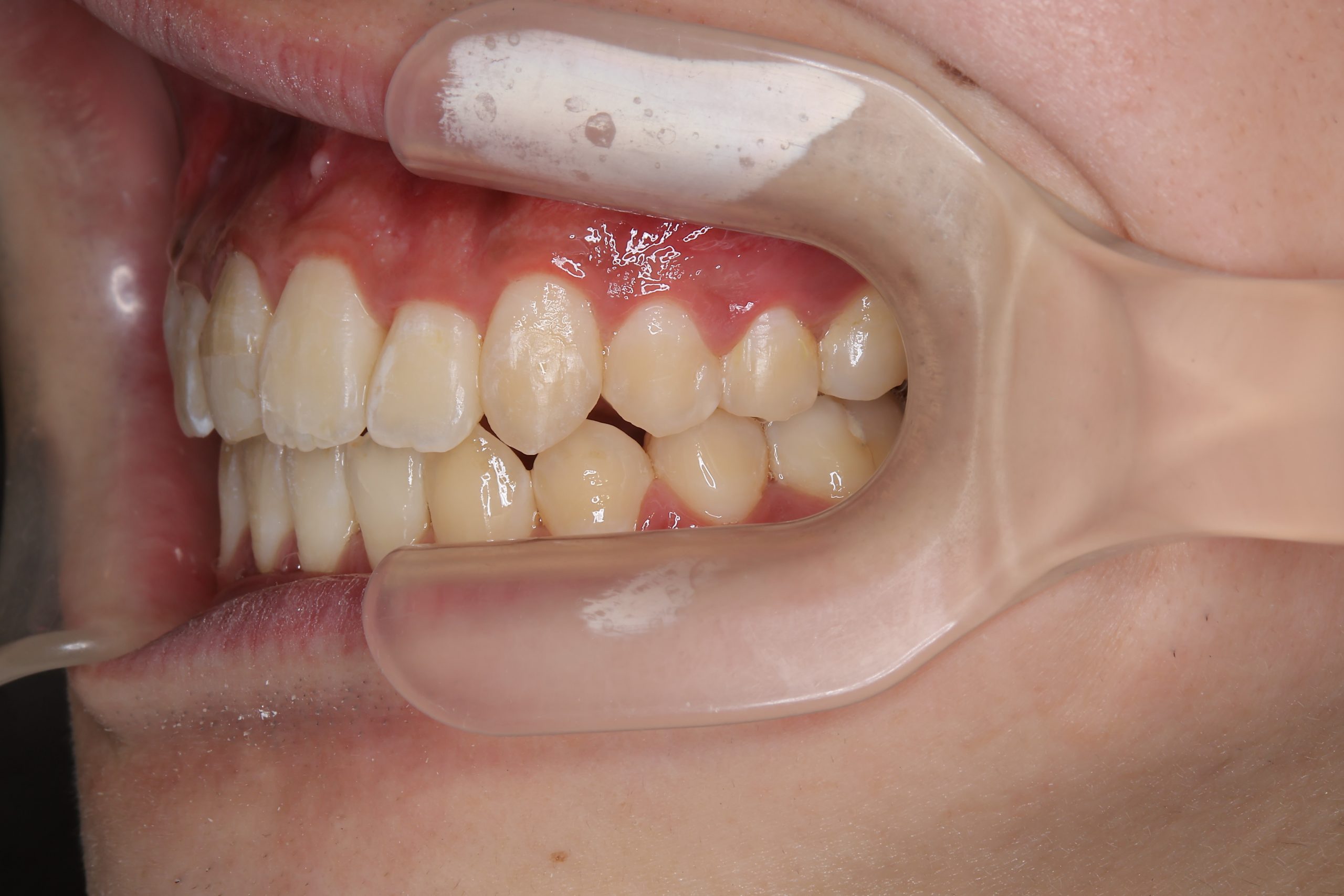 全顎ワイヤー矯正　症例_798