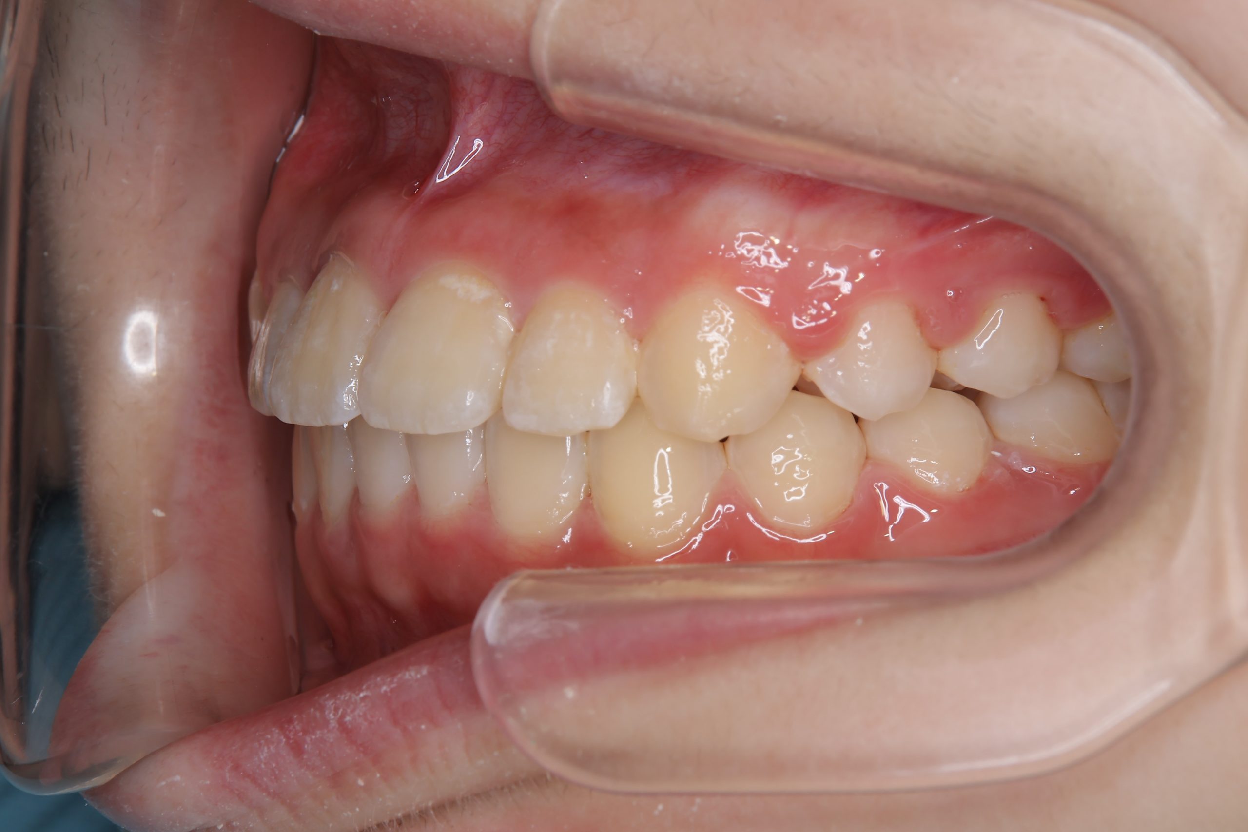 全顎ワイヤー矯正　症例_805