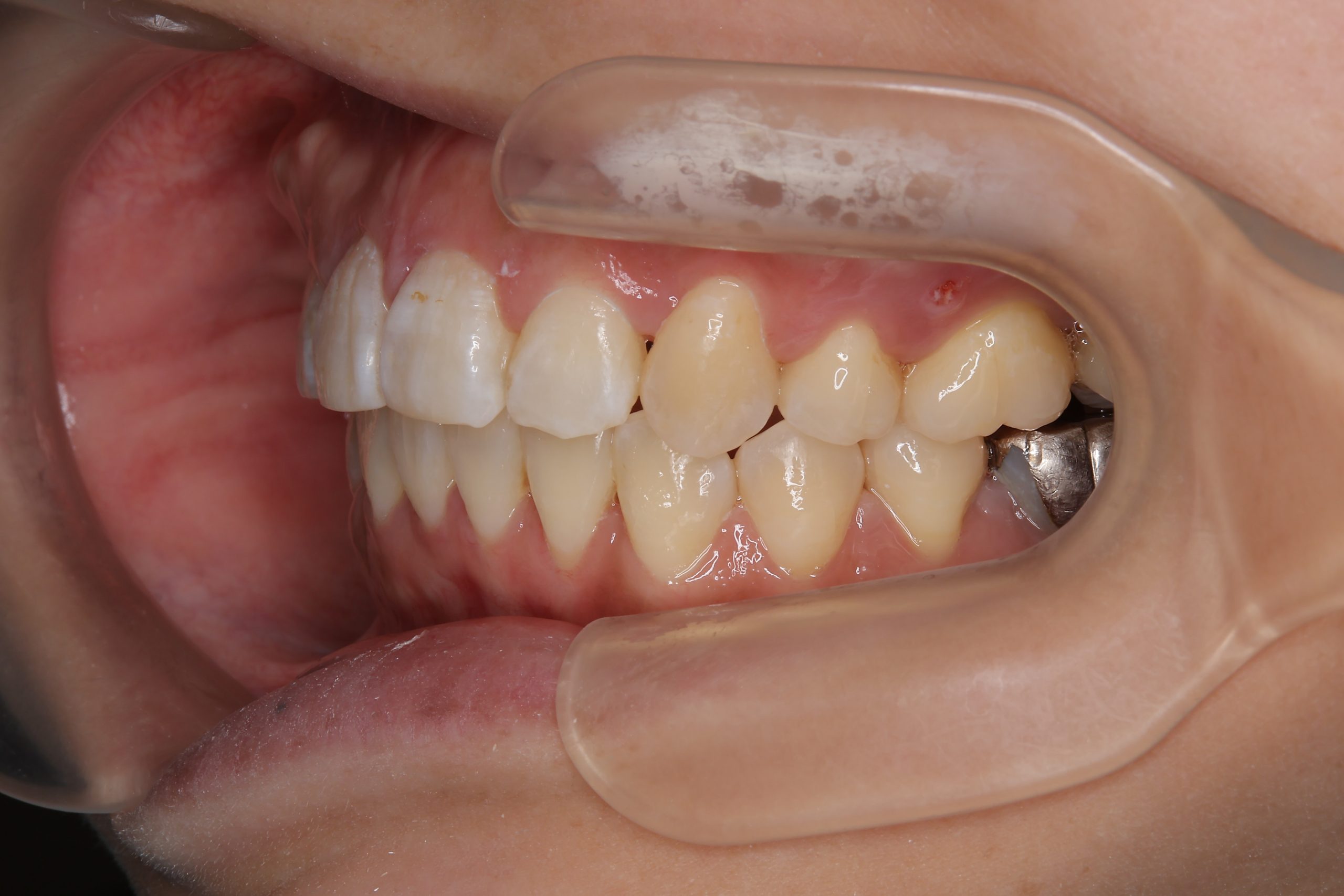 全顎ワイヤー矯正　症例_814