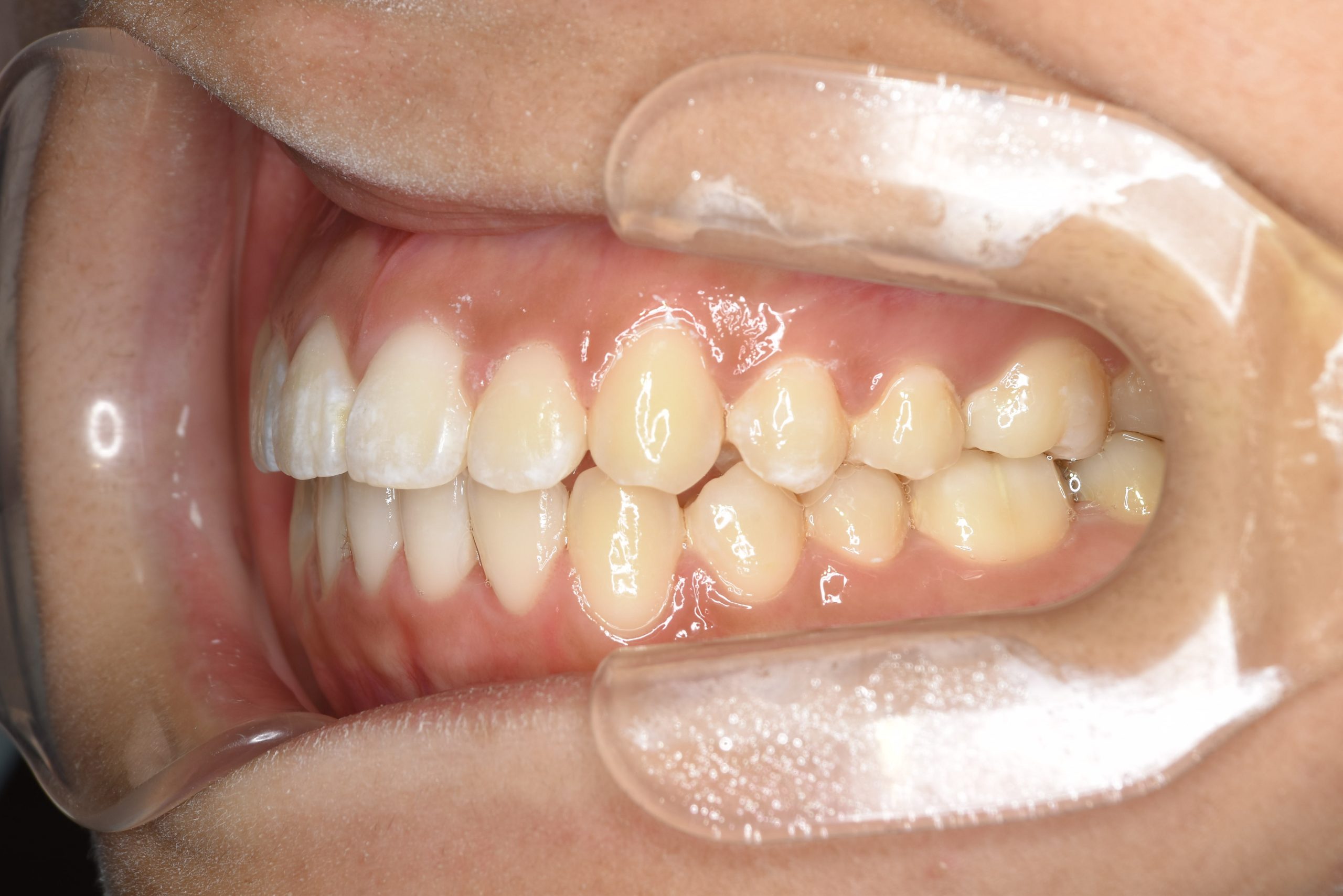 全顎ワイヤー矯正　症例_839