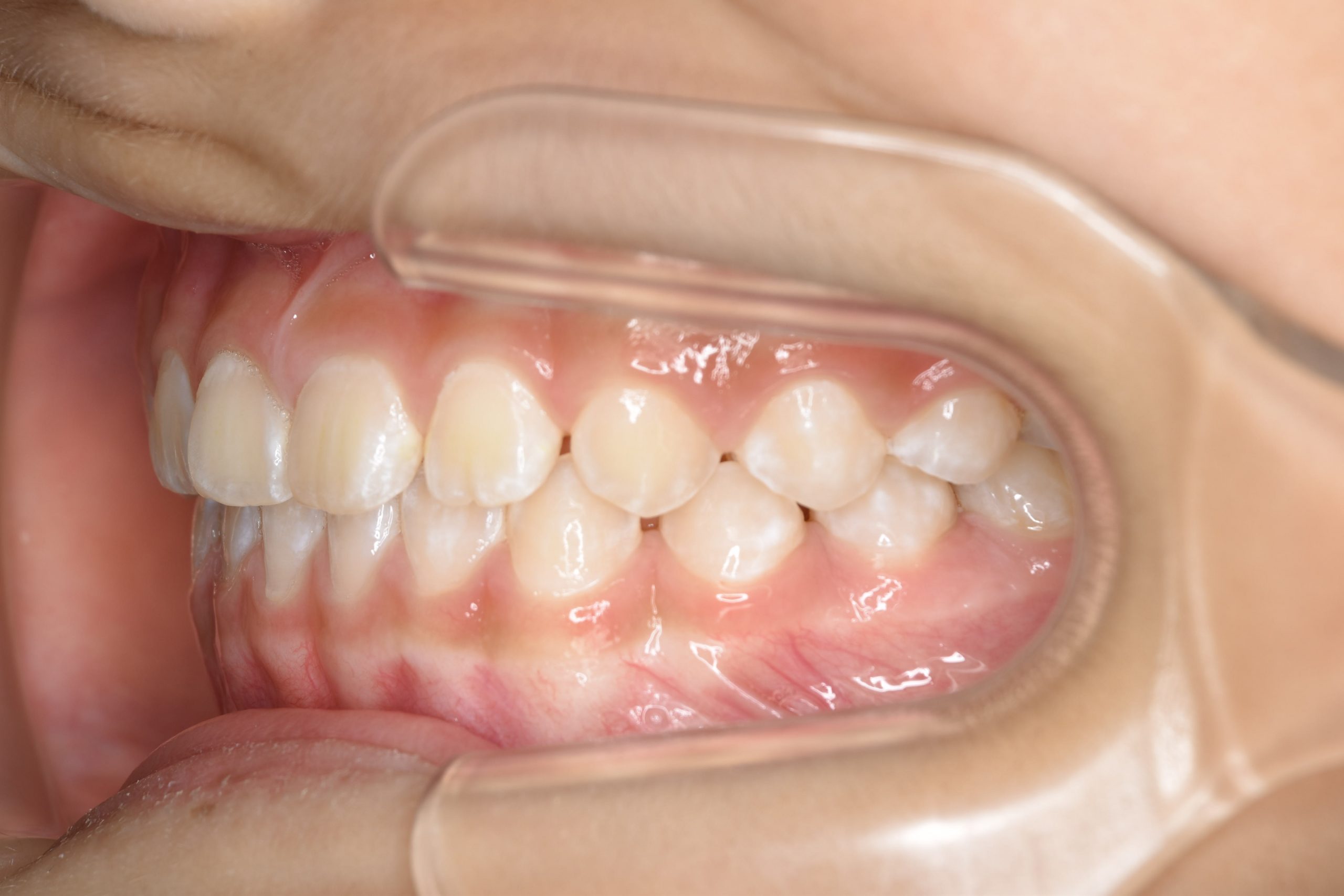 全顎ワイヤー矯正　症例_858