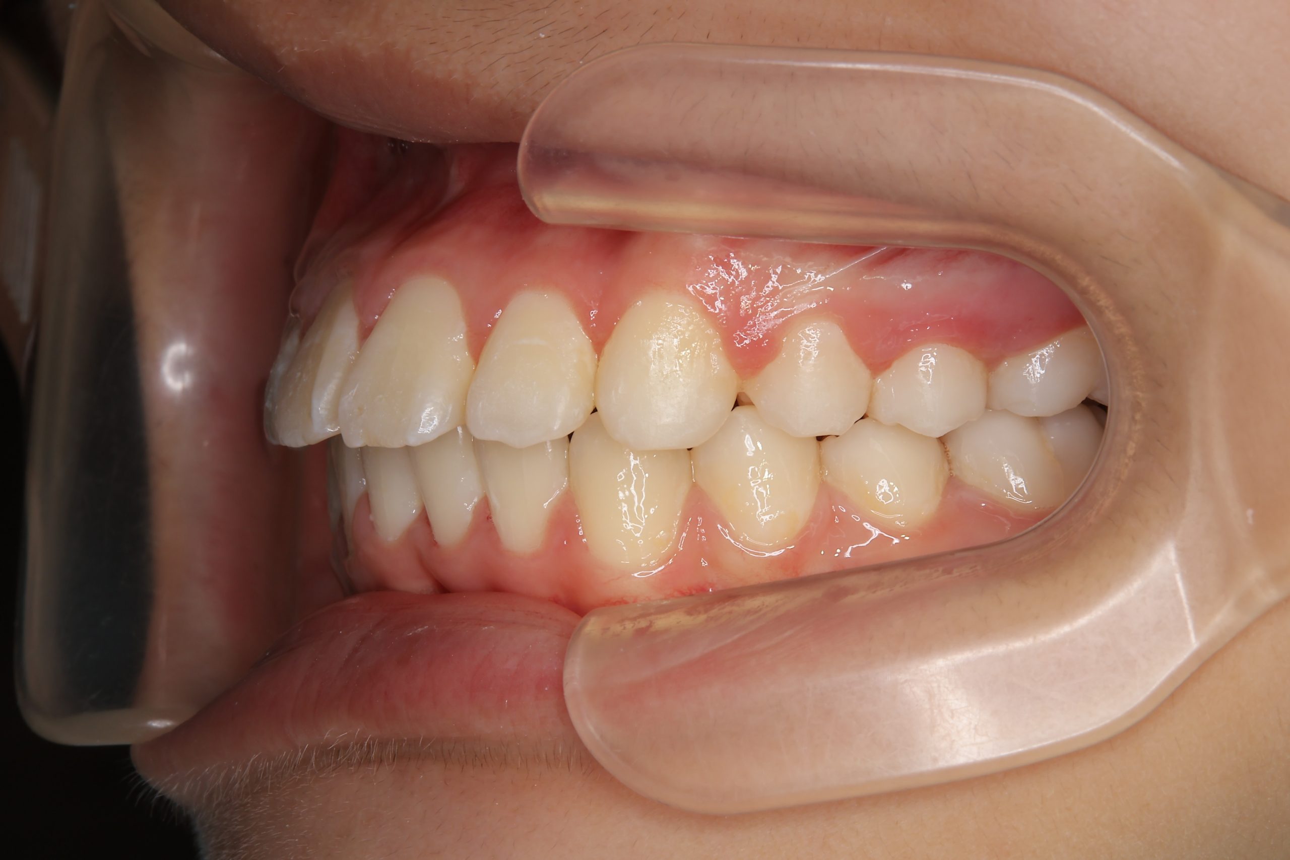 全顎ワイヤー矯正　症例_1324