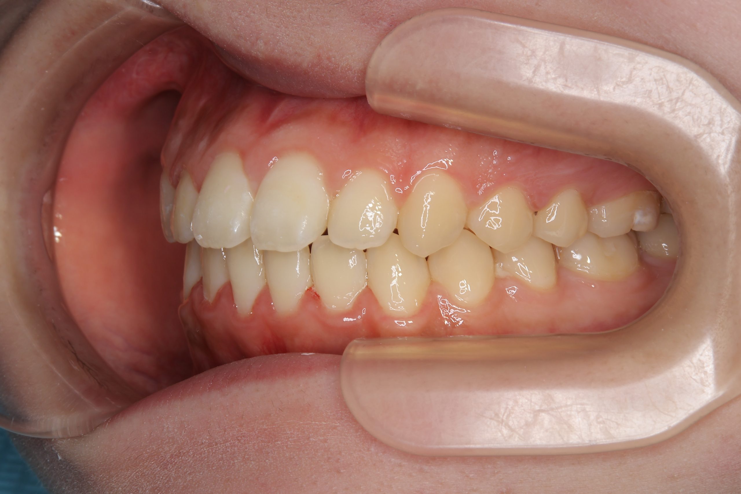 全顎ワイヤー矯正　症例_1409